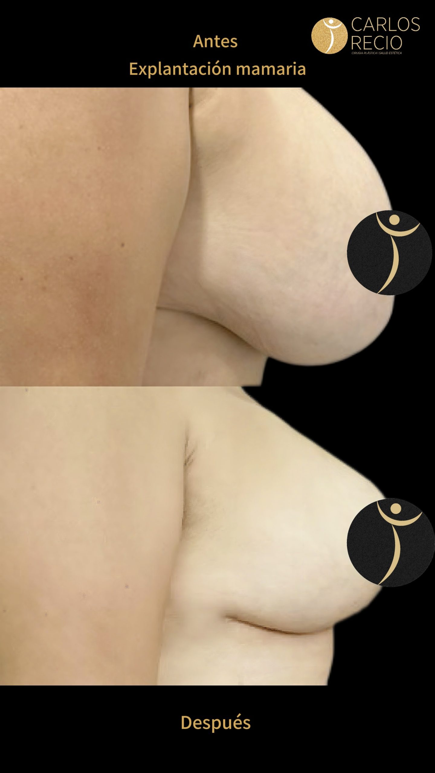 Explantación Mamaria en Cali IMG_3681