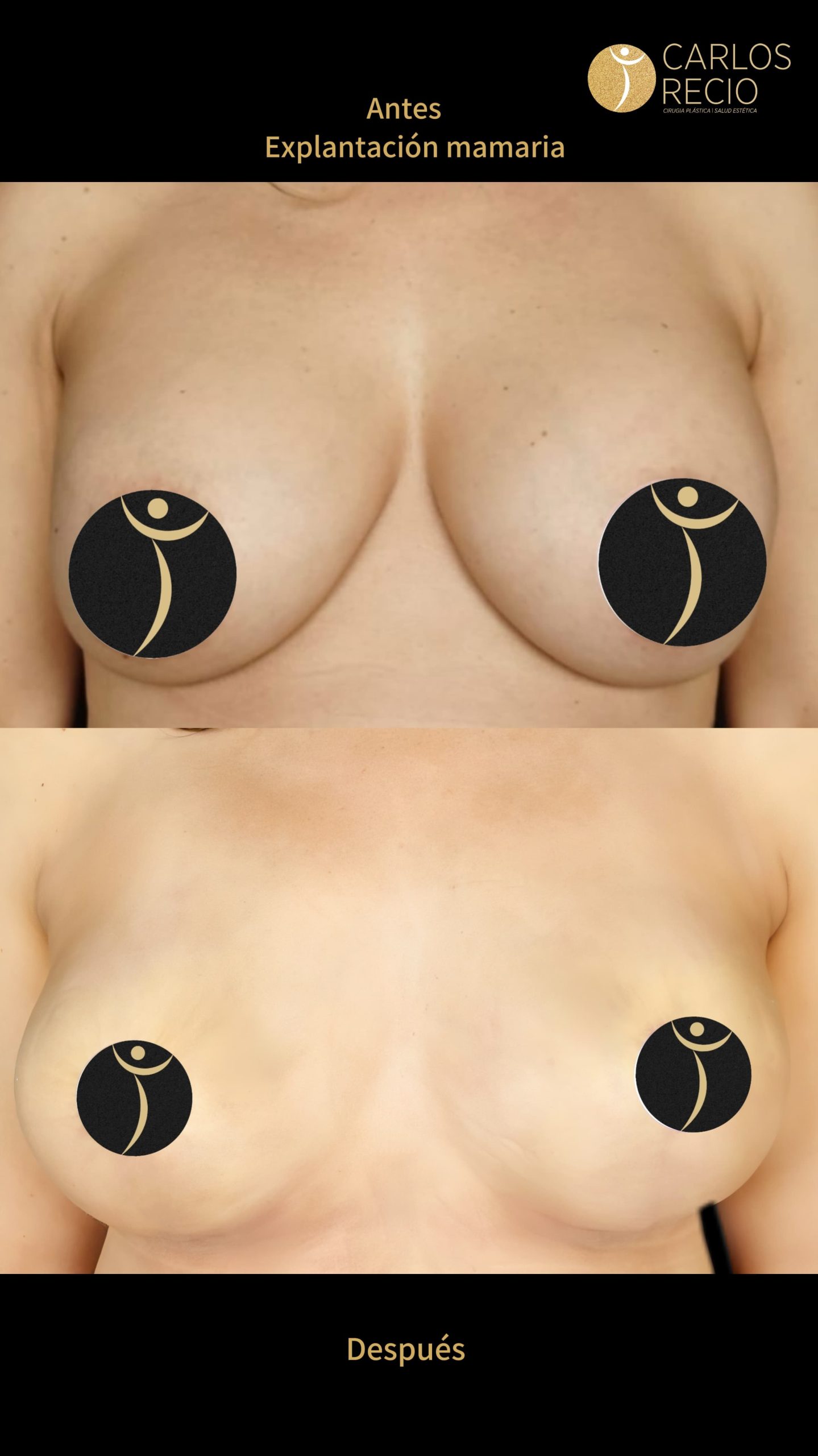 Explantación Mamaria en Cali IMG_3690