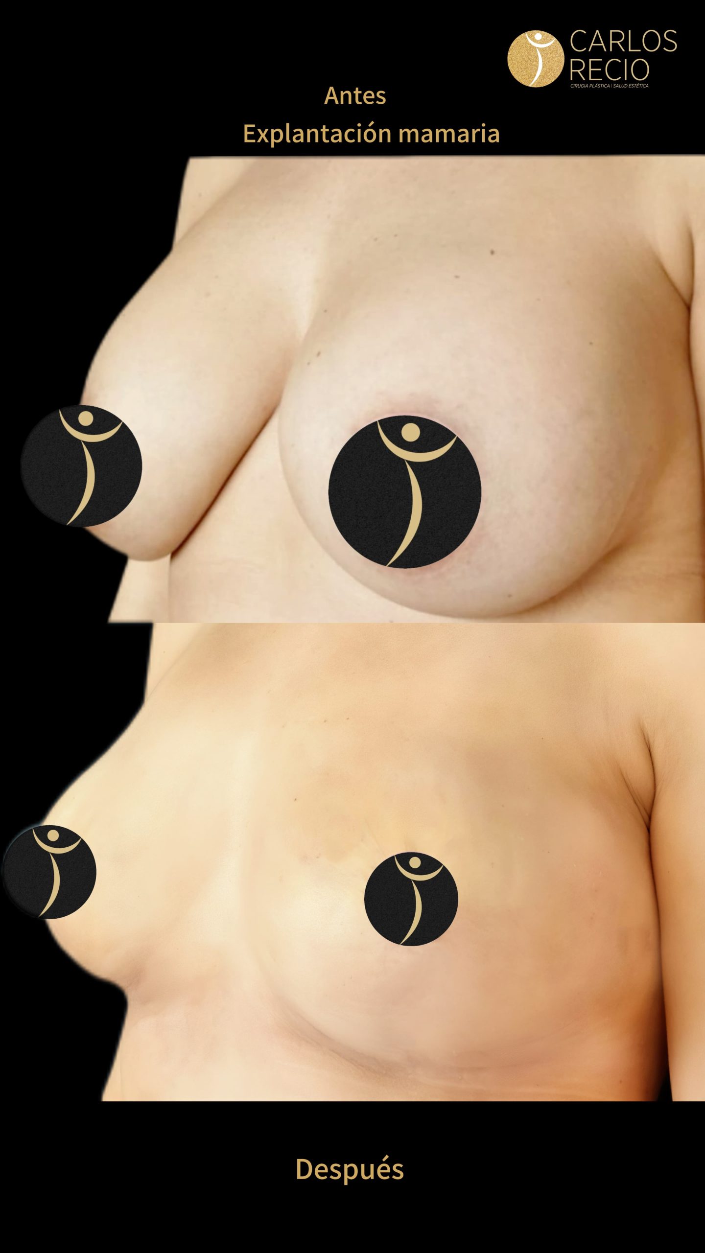 Explantación Mamaria en Cali IMG_3695