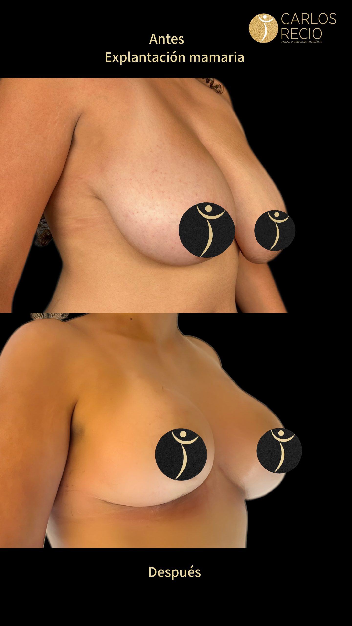 Explantación Mamaria en Cali IMG_3711