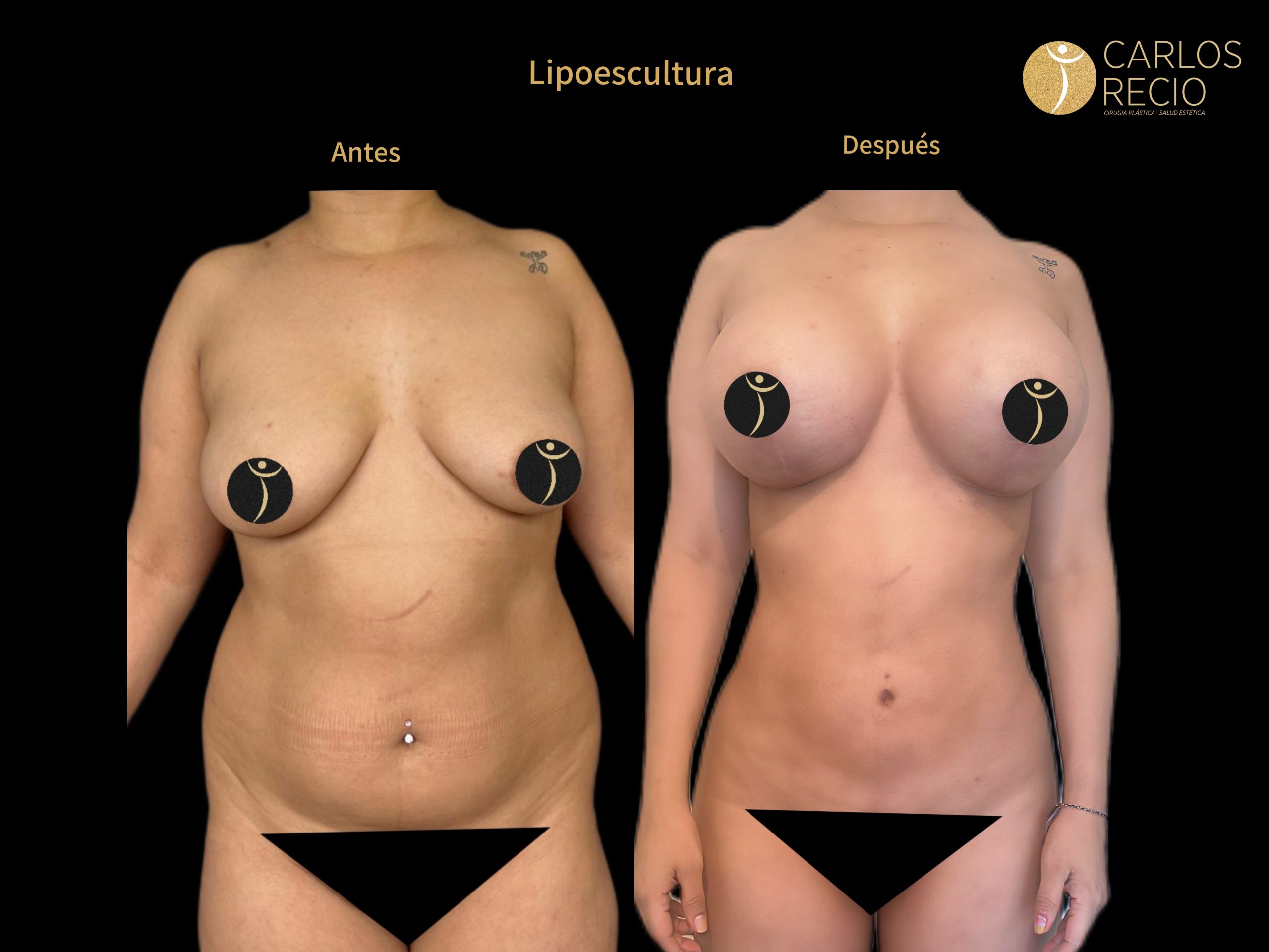 Lipoescultura IMG_3795