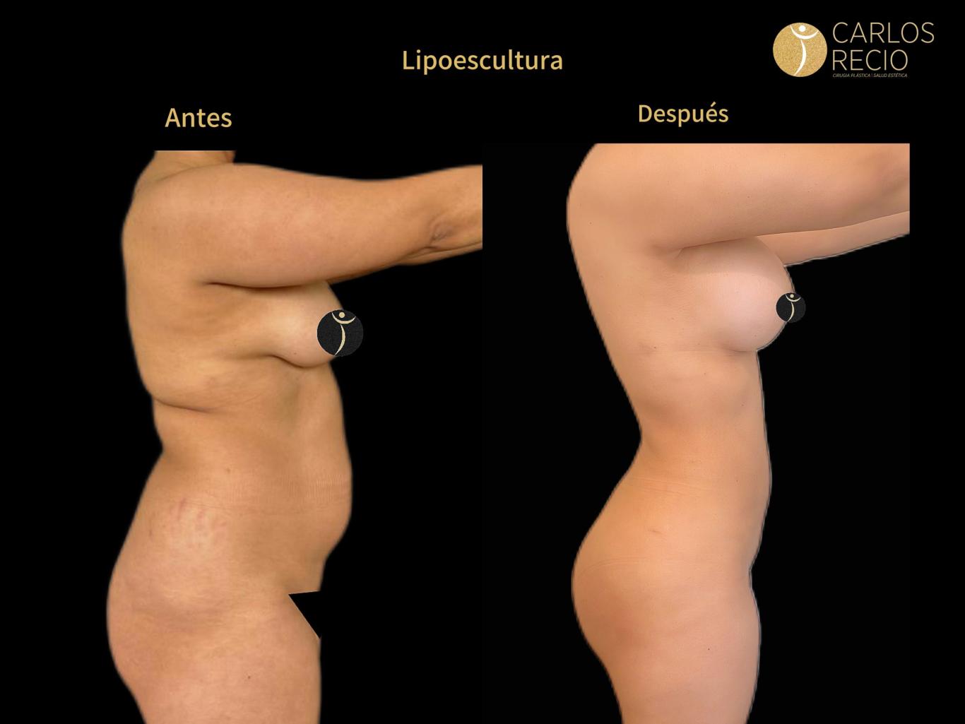 para que sirve la lipo c Lipoescultura L_141