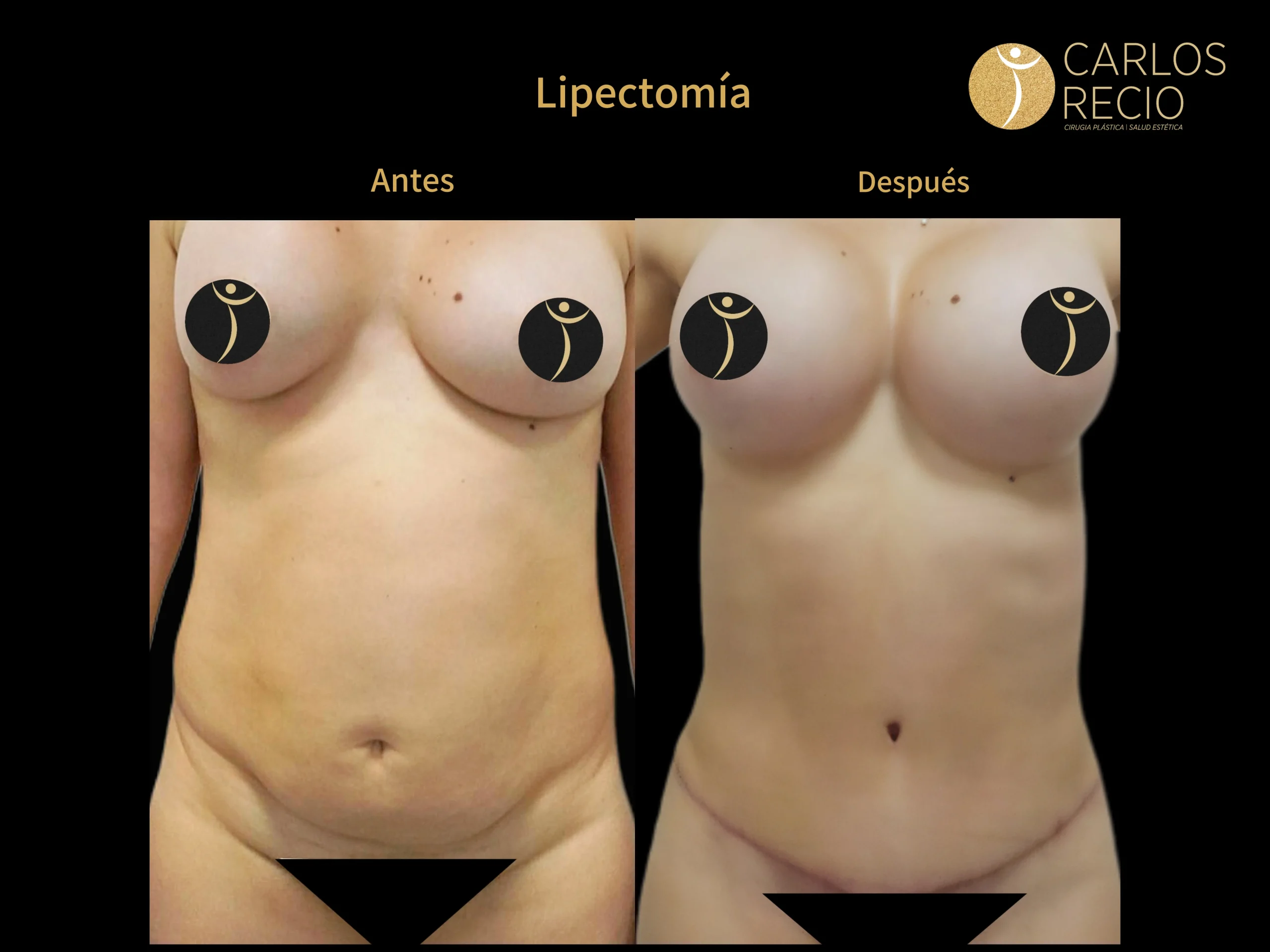 Abdominoplastia en Cali IMG_3881