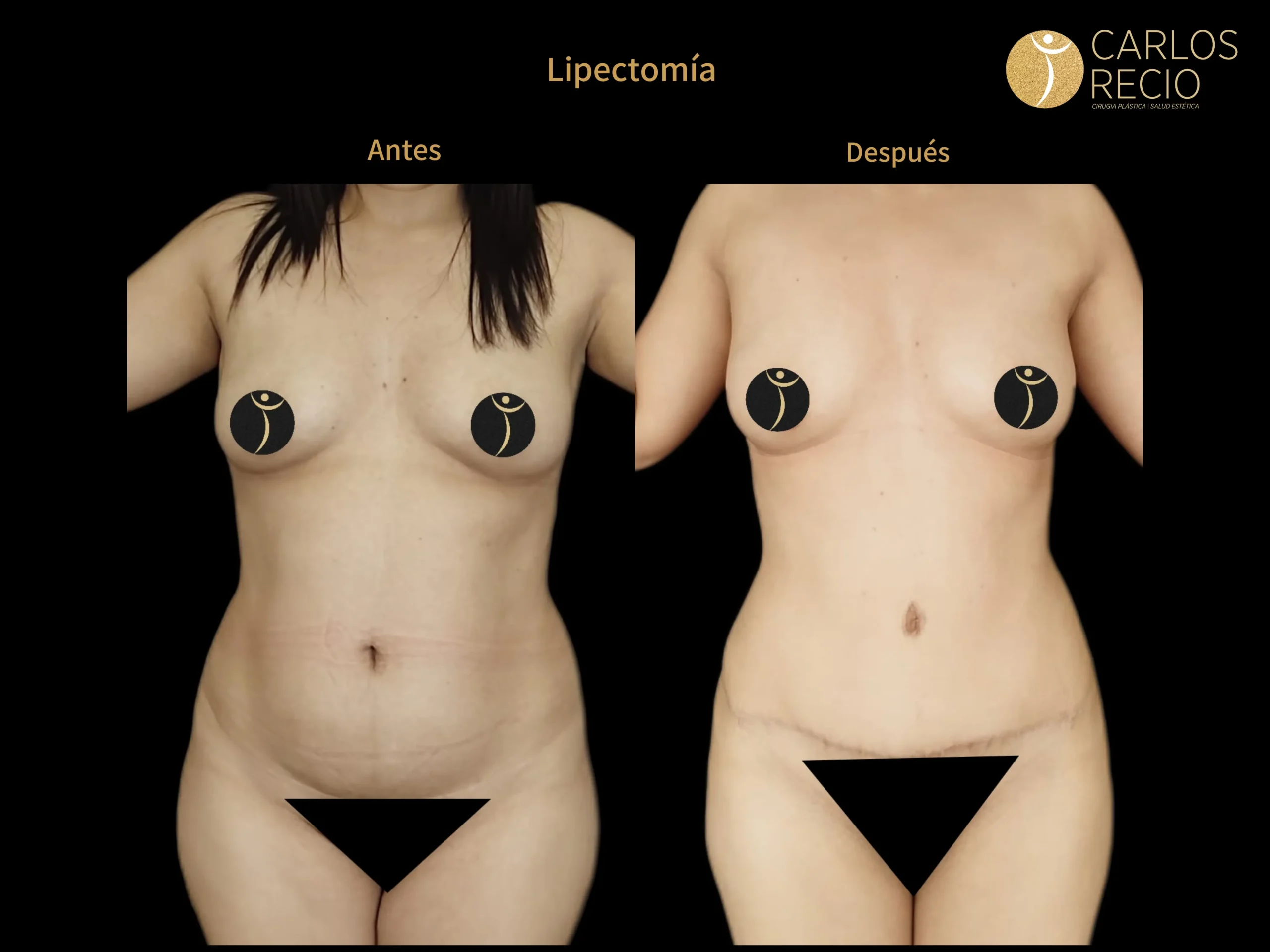 Abdominoplastia en Cali IMG_3944