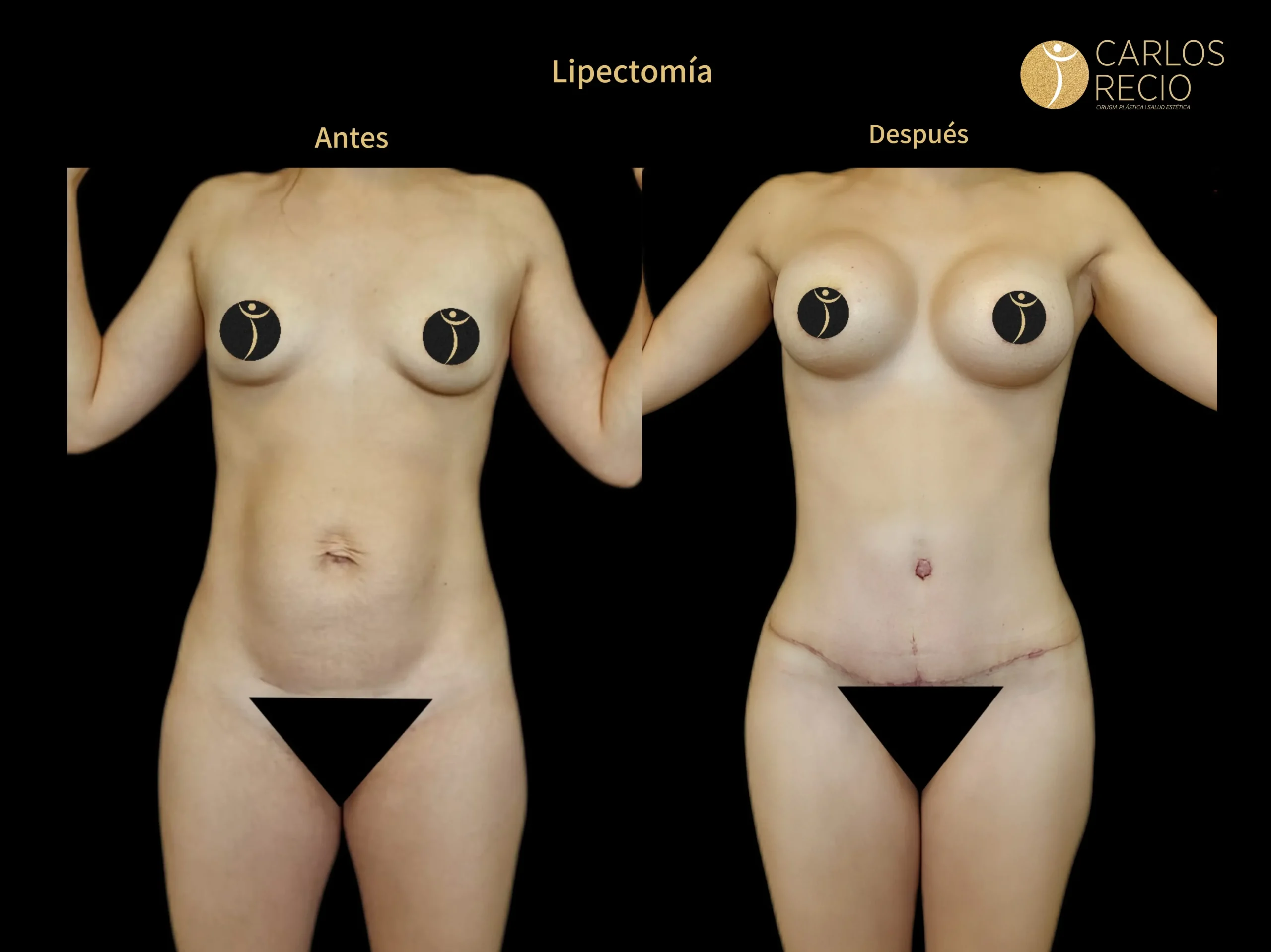 Abdominoplastia en Cali IMG_3959