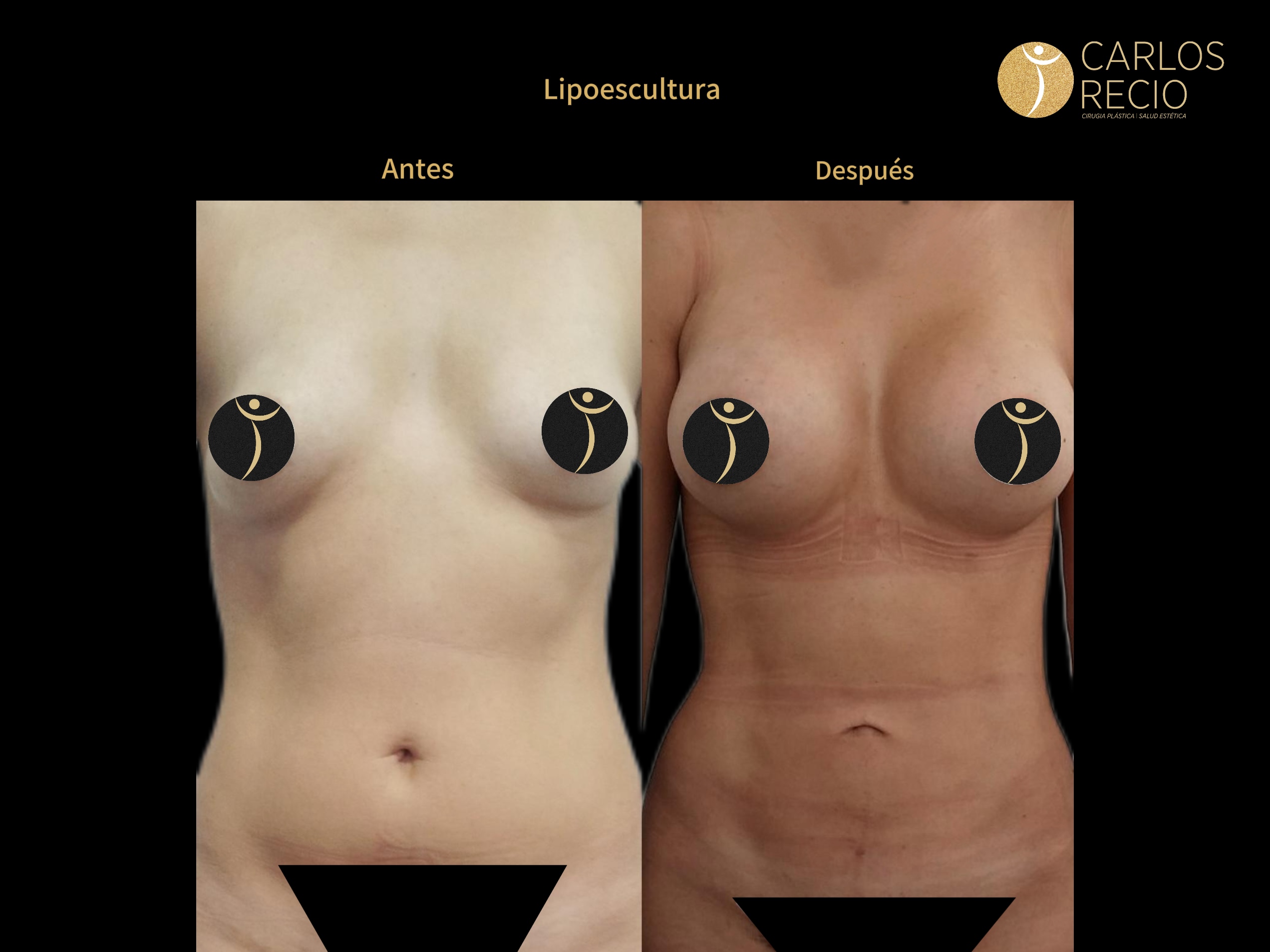 Lipoescultura IMG_3996