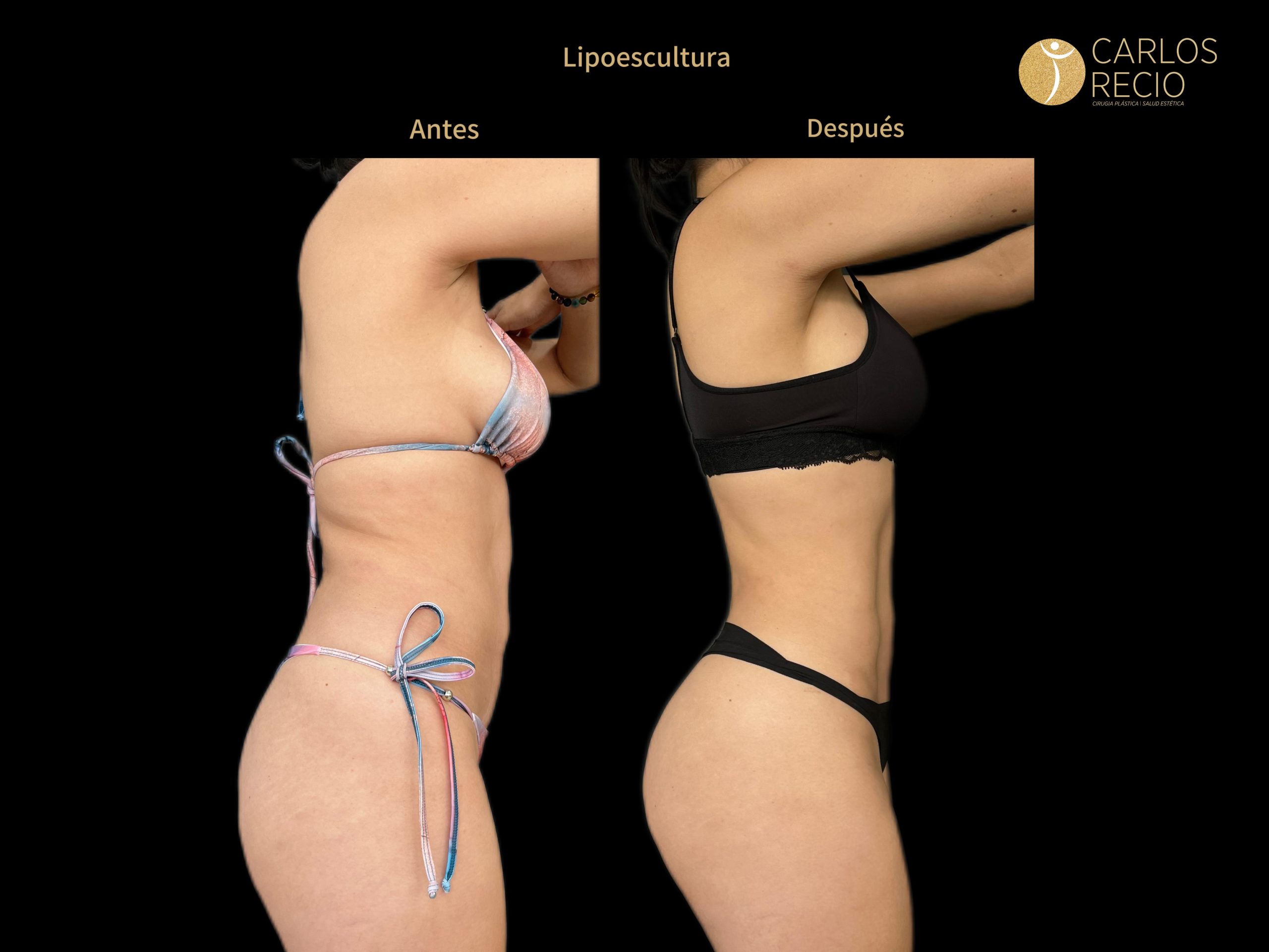 Lipoescultura IMG_3998