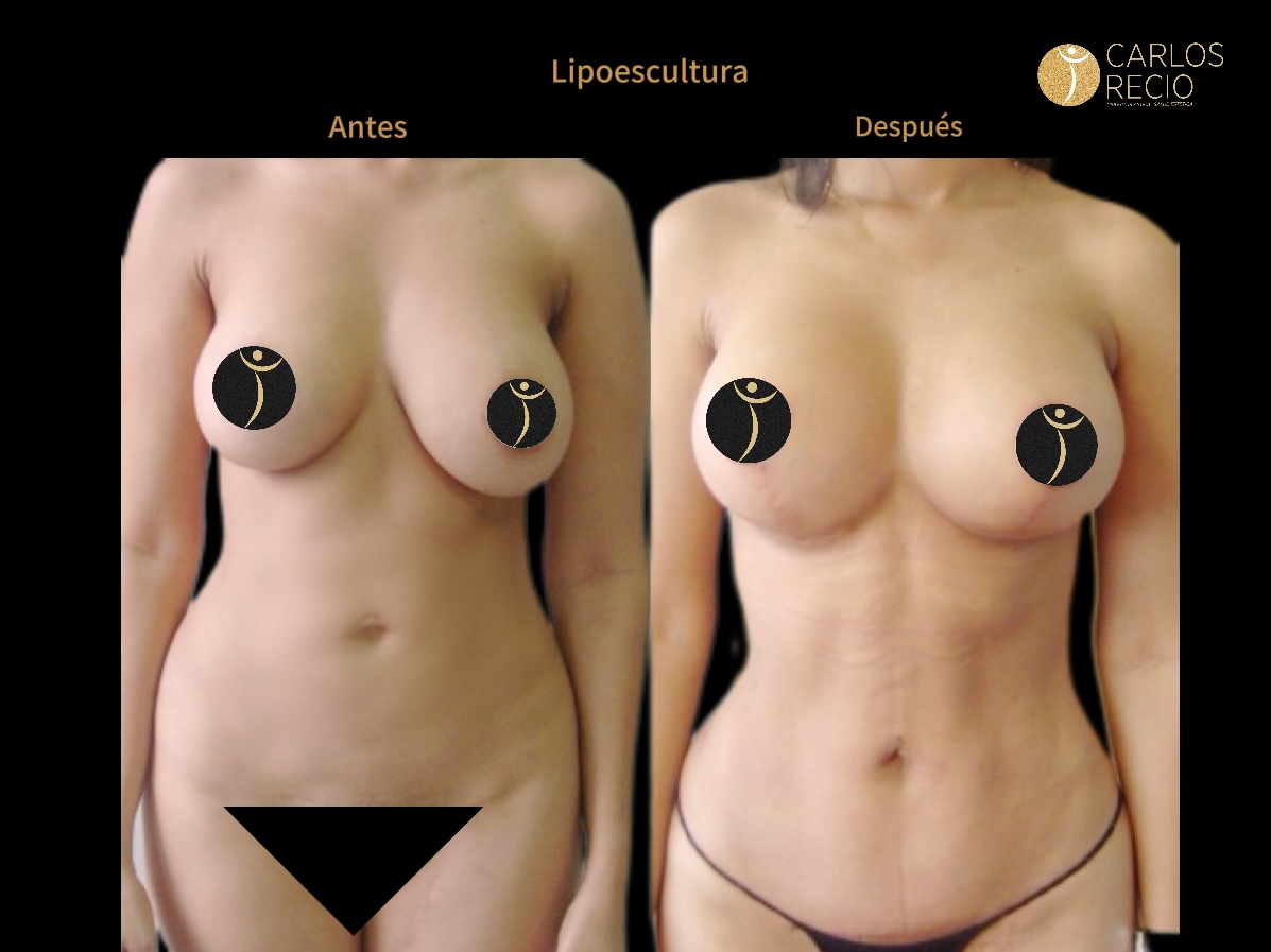 Lipoescultura IMG_4009