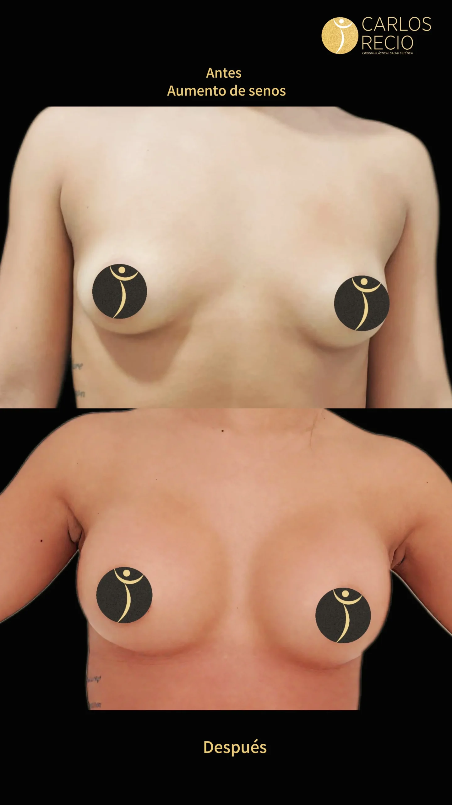 Aumento de senos en Cali IMG_4103 (1)