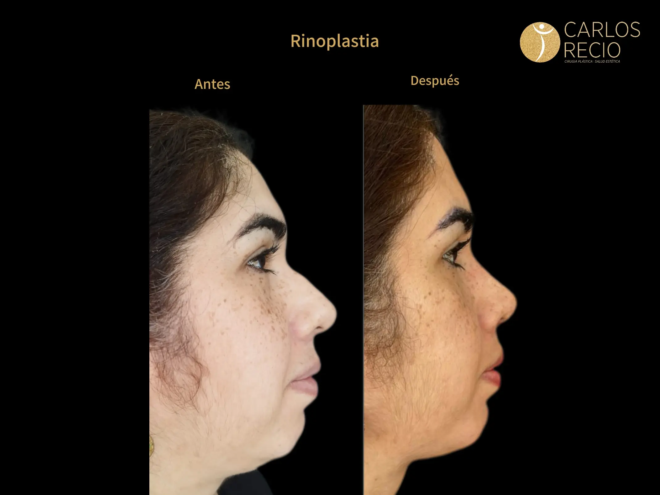 Rinoplastia en Cali – Cirugía de Nariz Rinoplastia en Cali