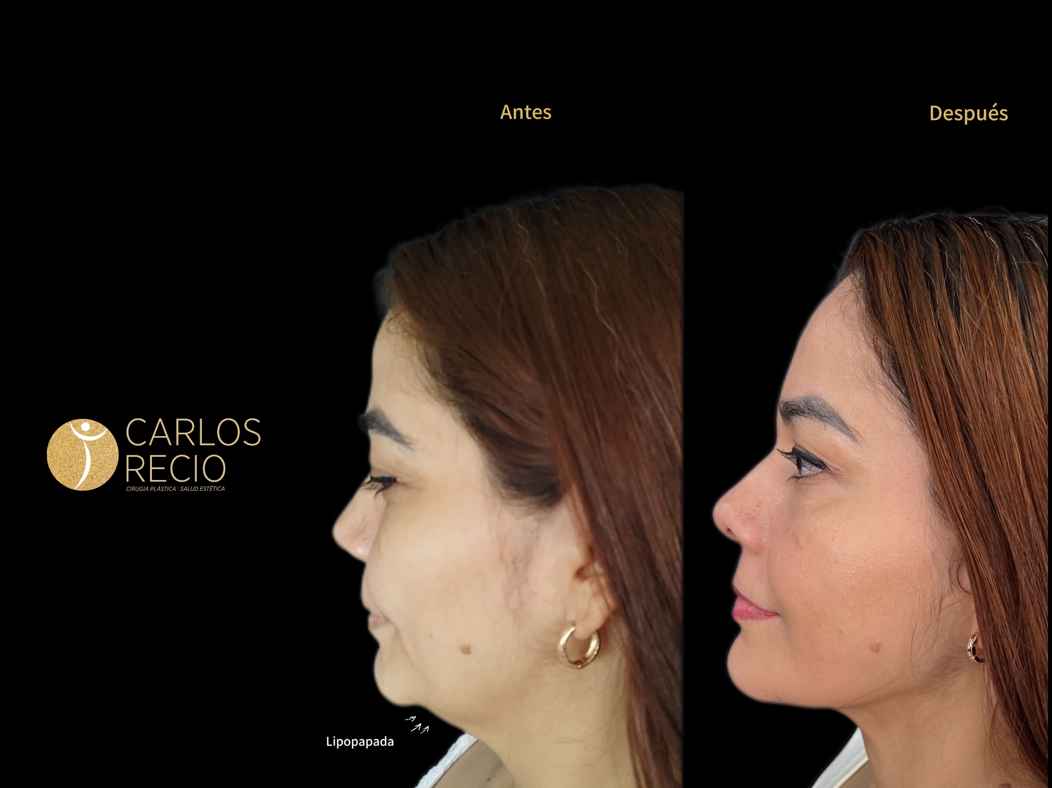 Liposucción de papada - Lipo-Papada IMG_4325