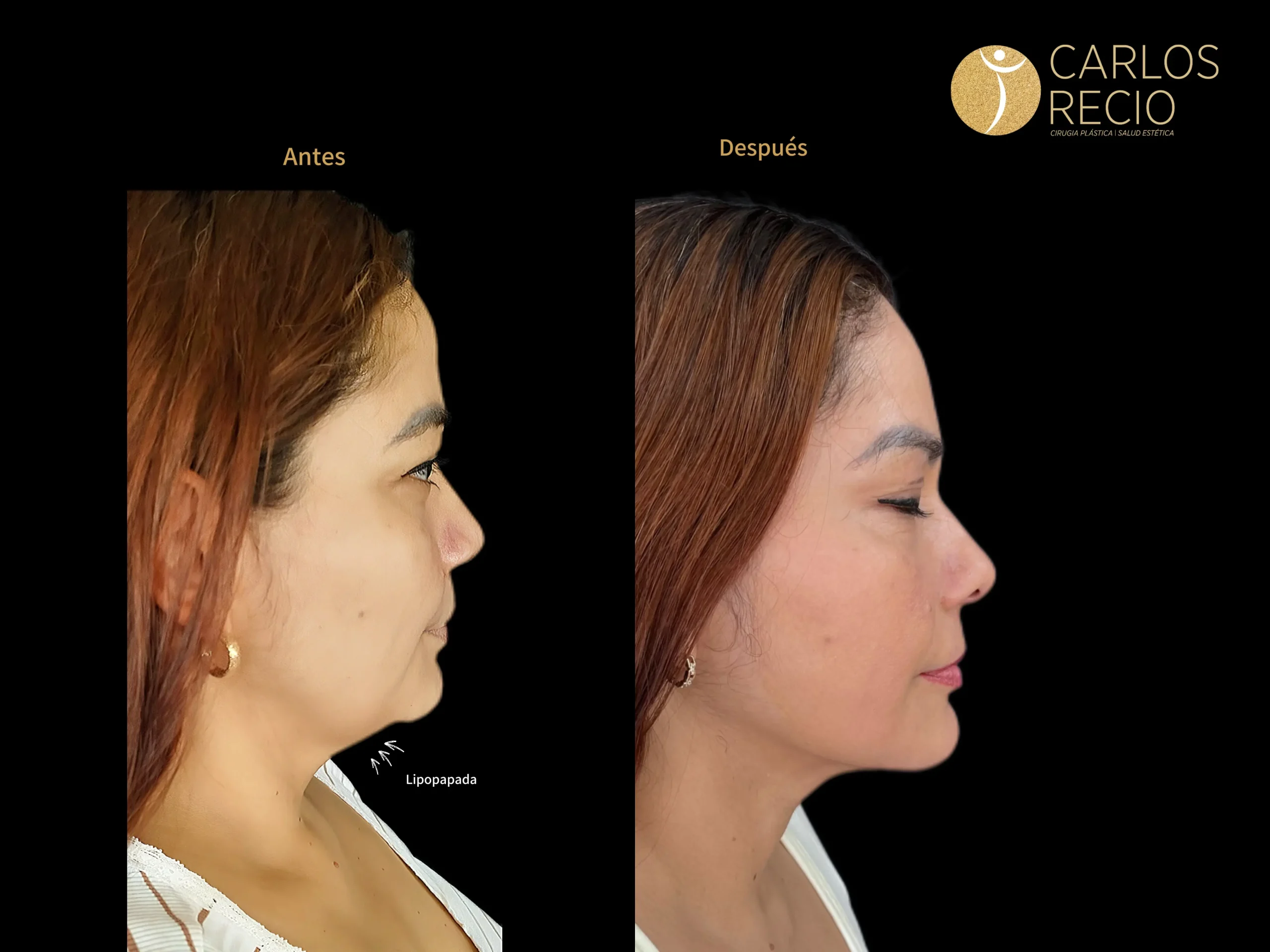 Liposucción de papada - Lipo-Papada IMG_4330