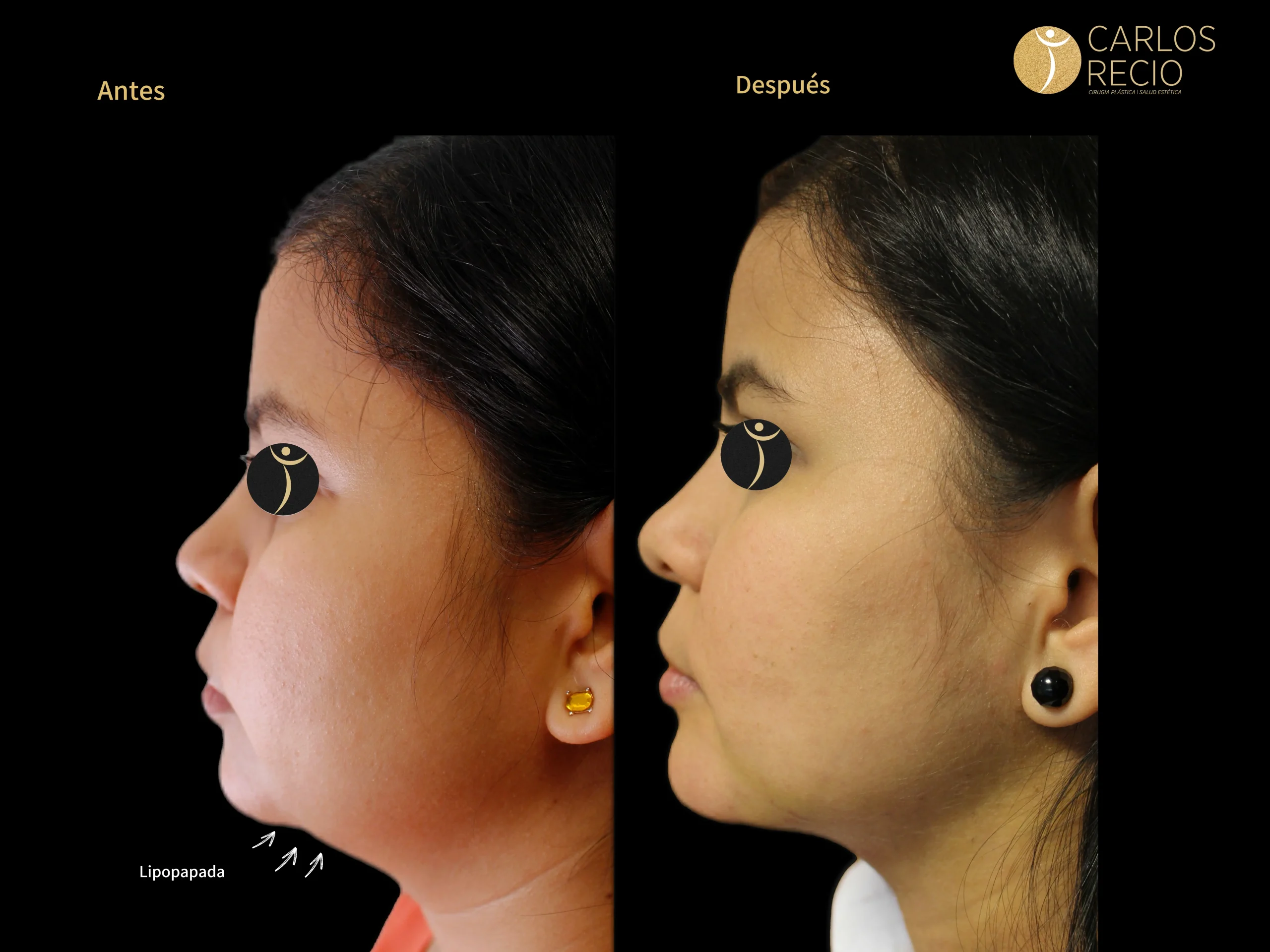 Liposucción de papada - Lipo-Papada IMG_4332