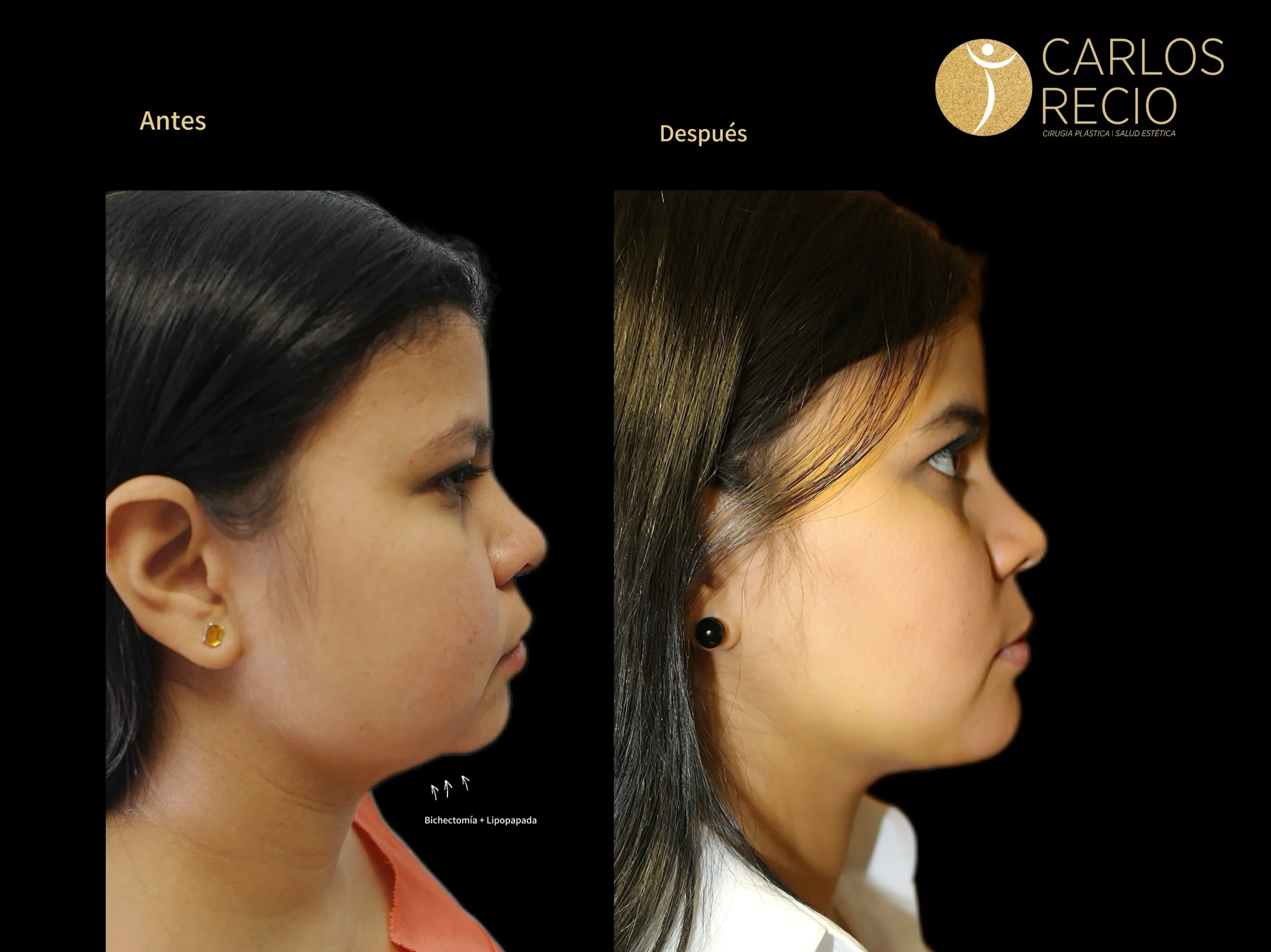 Cirugia de mejillas - Bichectomia IMG_4400