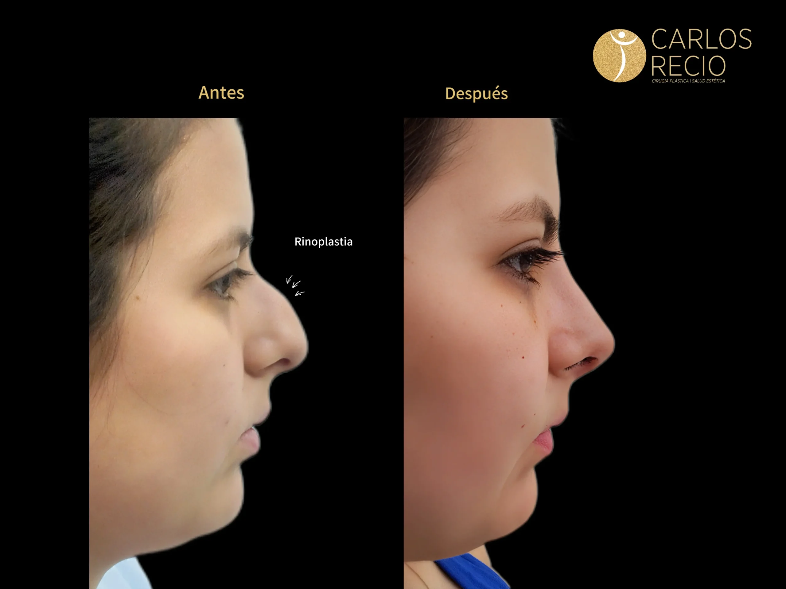 Rinoplastia en Cali – Cirugía de Nariz IMG_4595