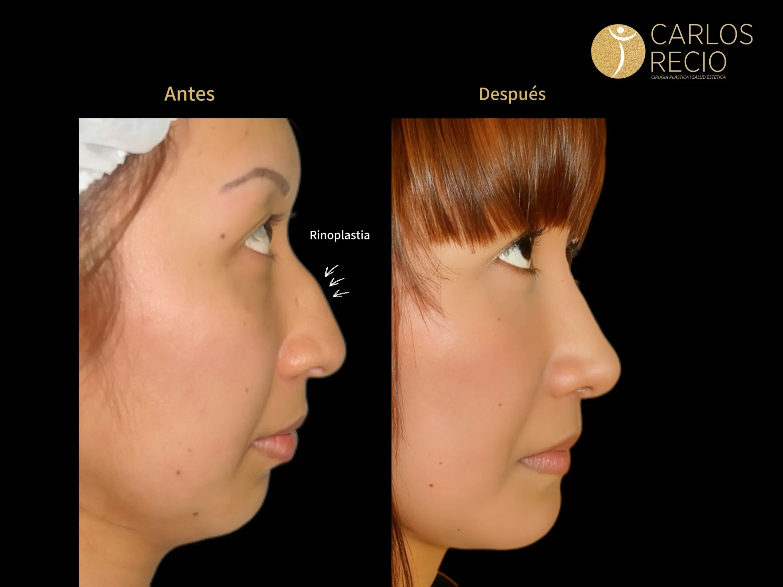 Rinoplastia en Cali – Cirugía de Nariz IMG_4623