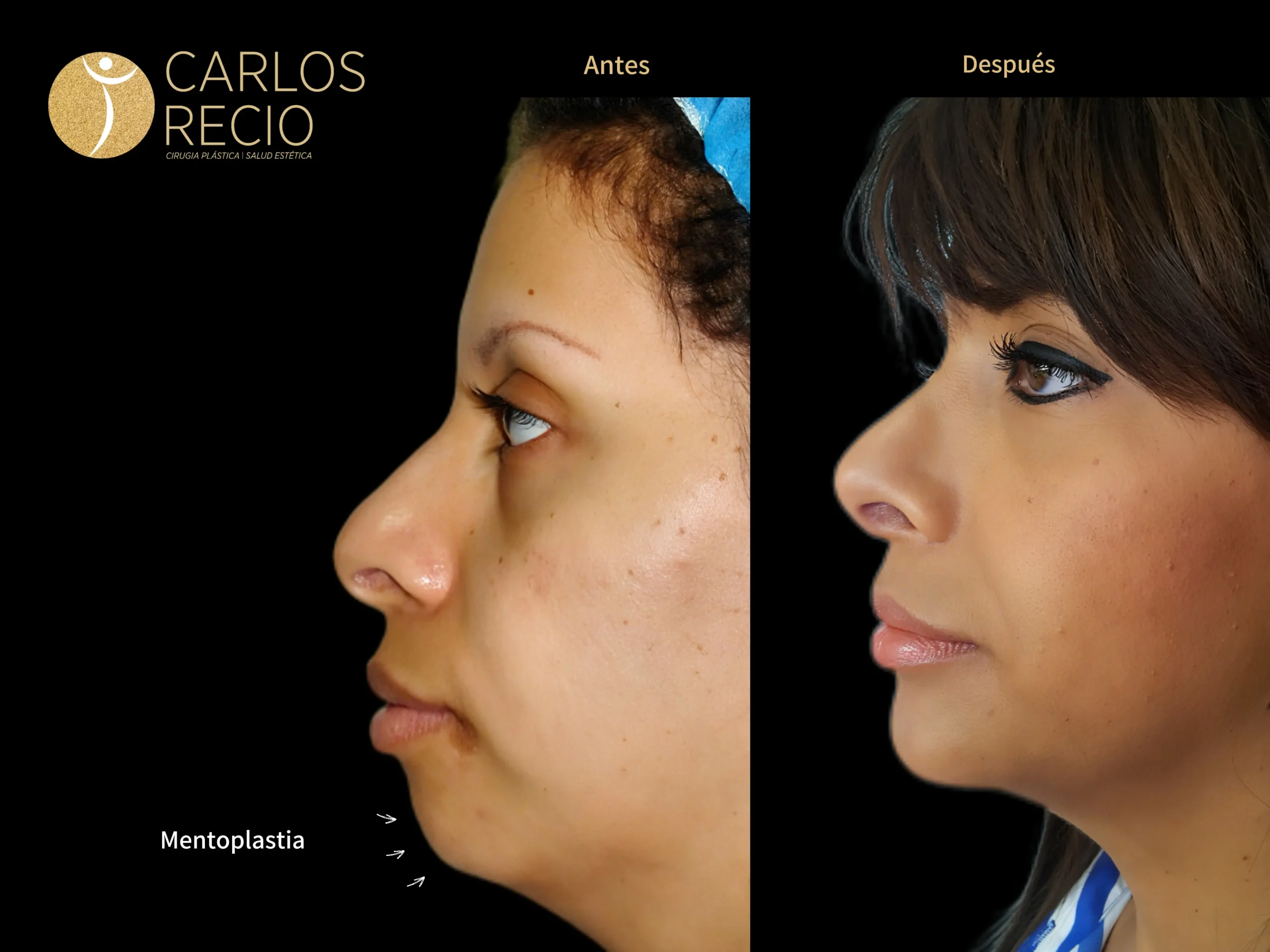 Cirugia de Menton - Mentoplastia IMG_4634