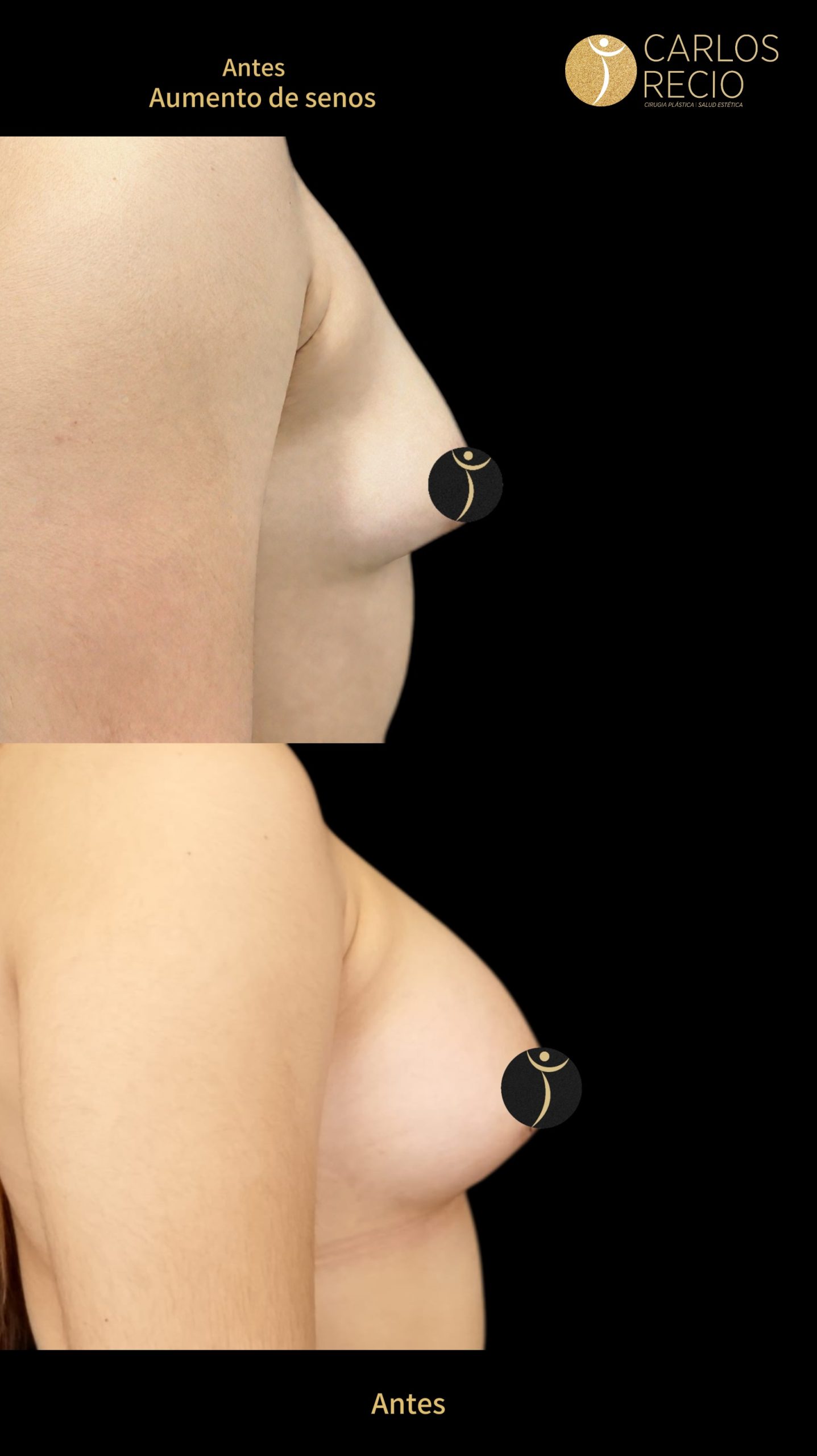 Aumento de senos en Cali IMG_4679