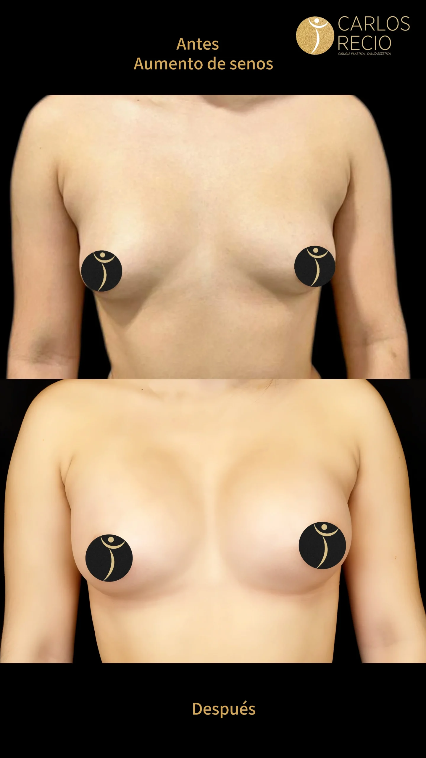 Aumento de senos en Cali IMG_4685