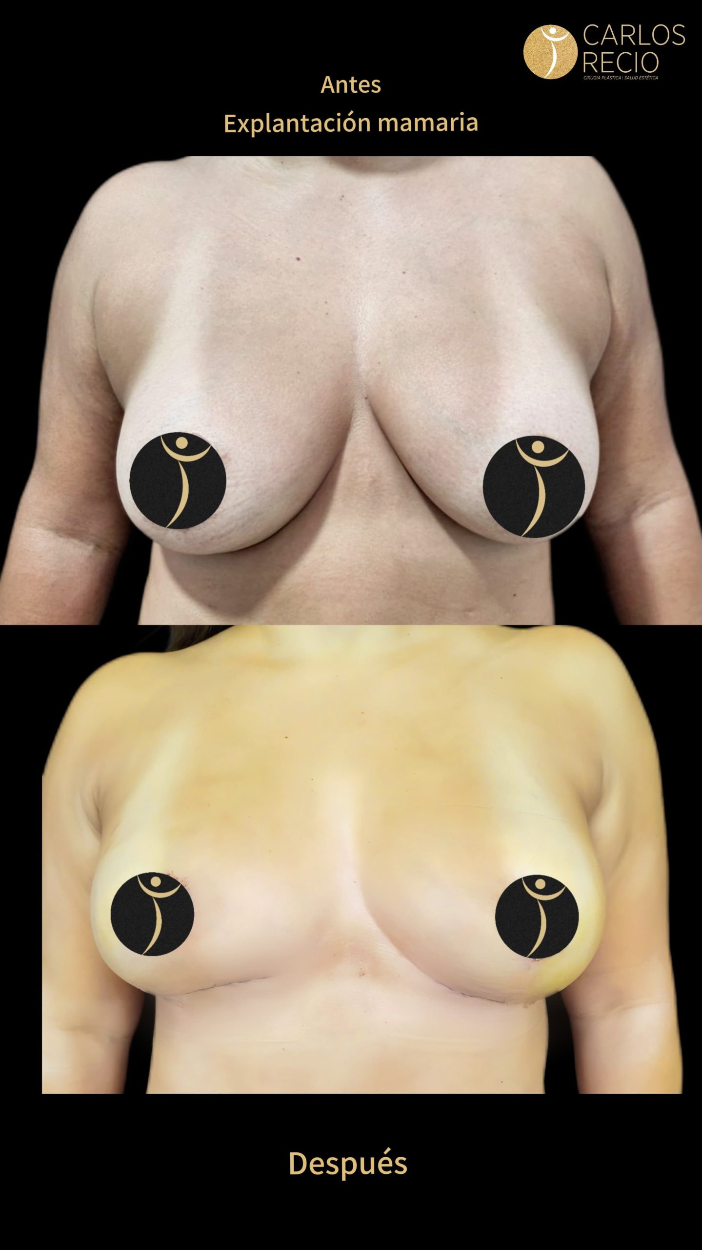 Explantación Mamaria en Cali IMG_4709