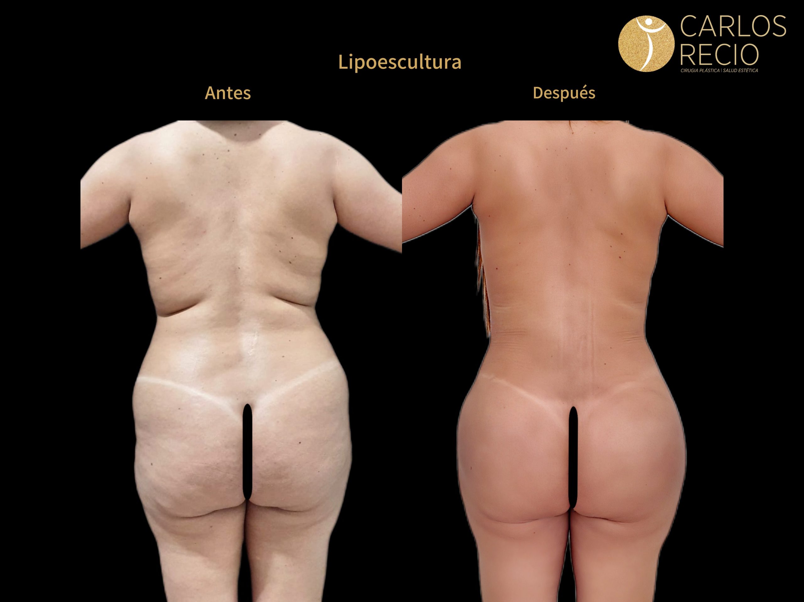 Lipoescultura IMG_4787