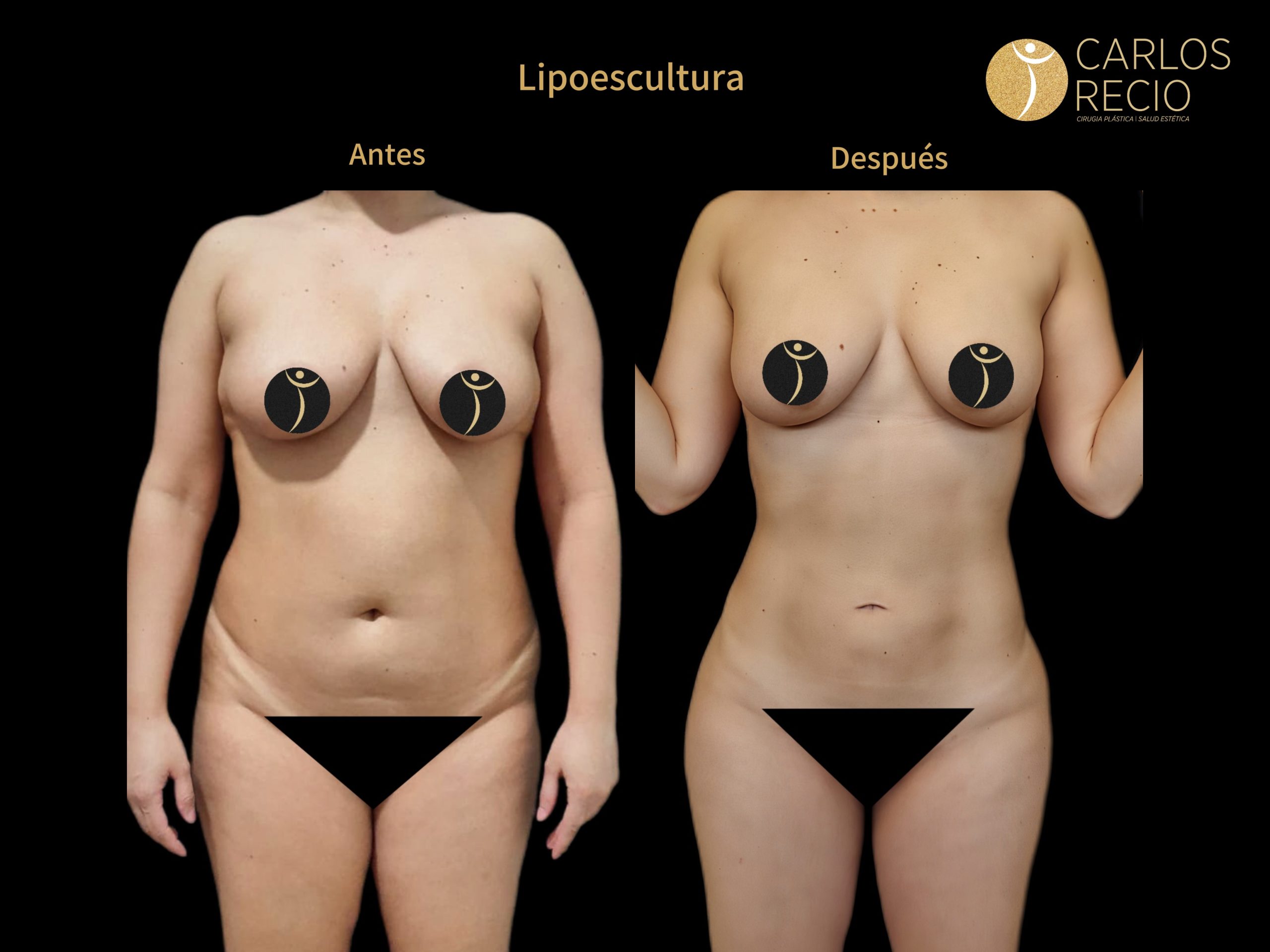 Lipoescultura IMG_4794