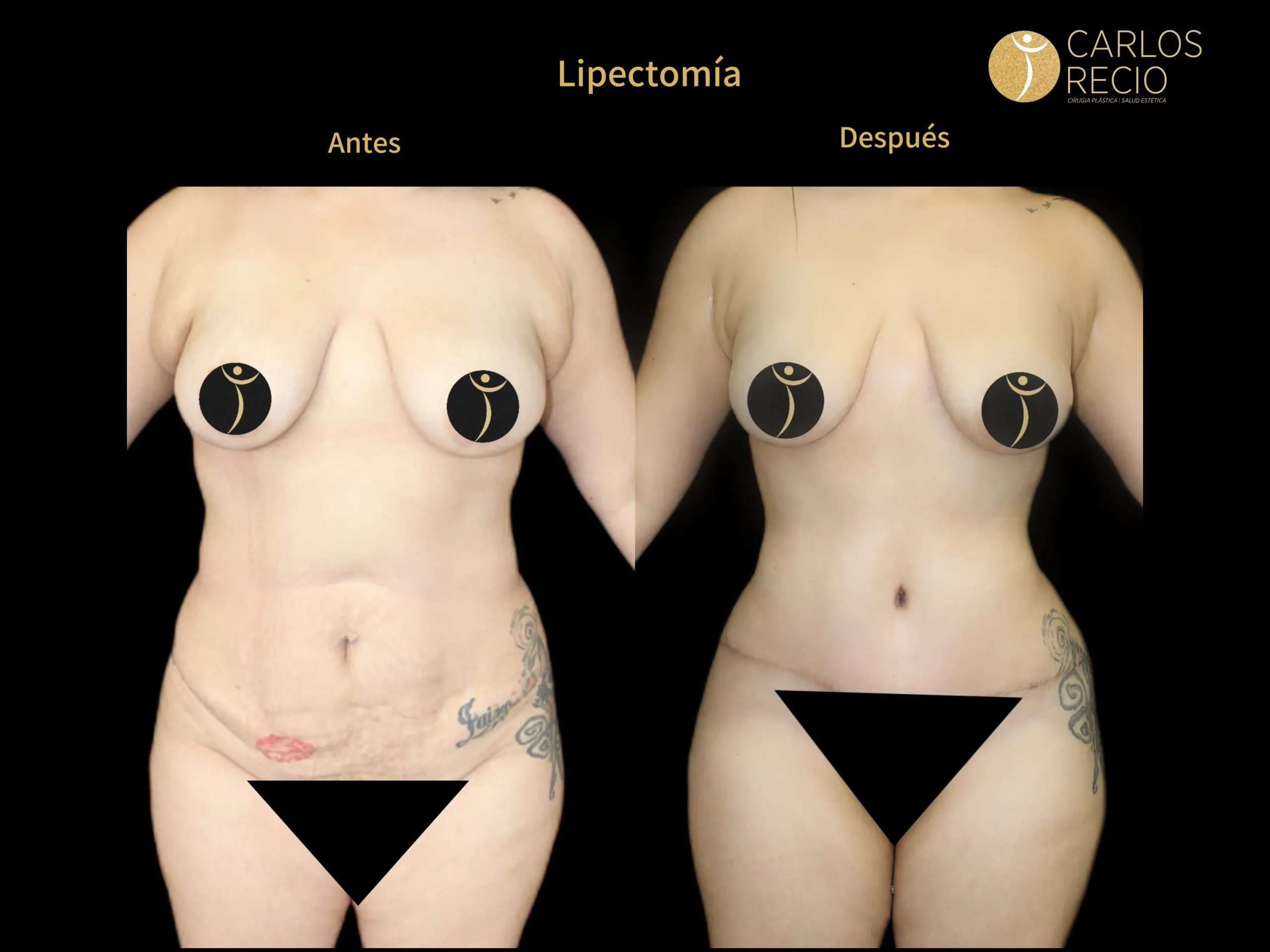 Abdominoplastia en Cali IMG_4880