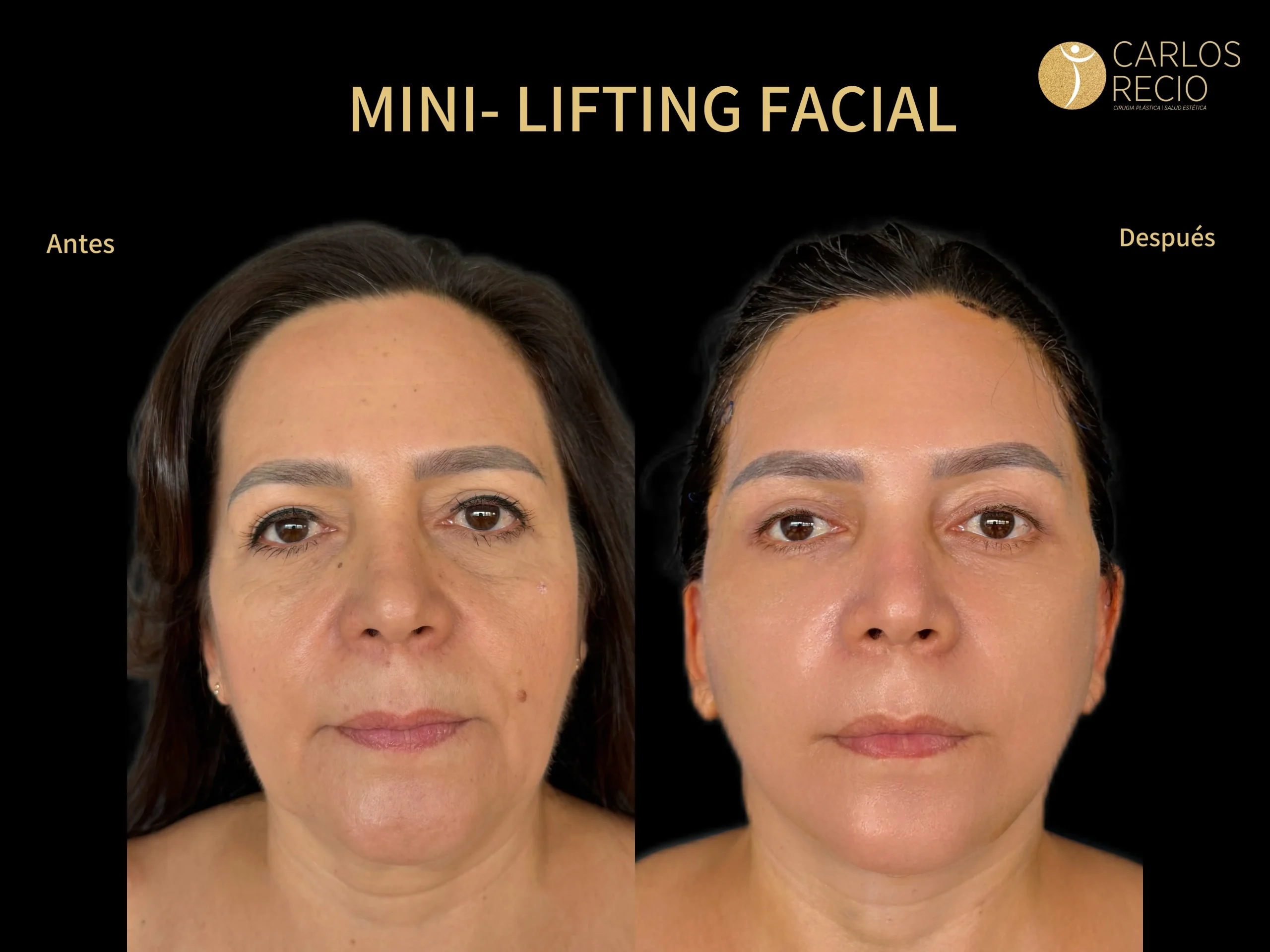 Mini-Lifting Facial IMG_5530