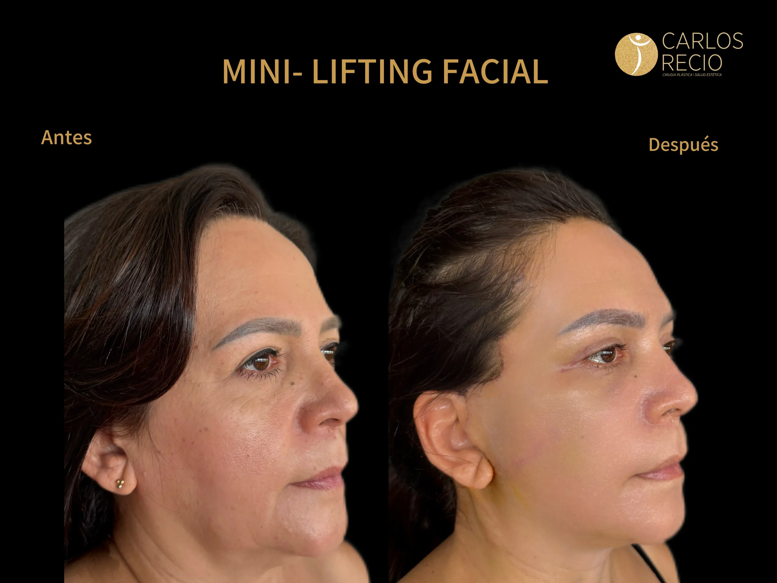 Mini-Lifting Facial IMG_5532