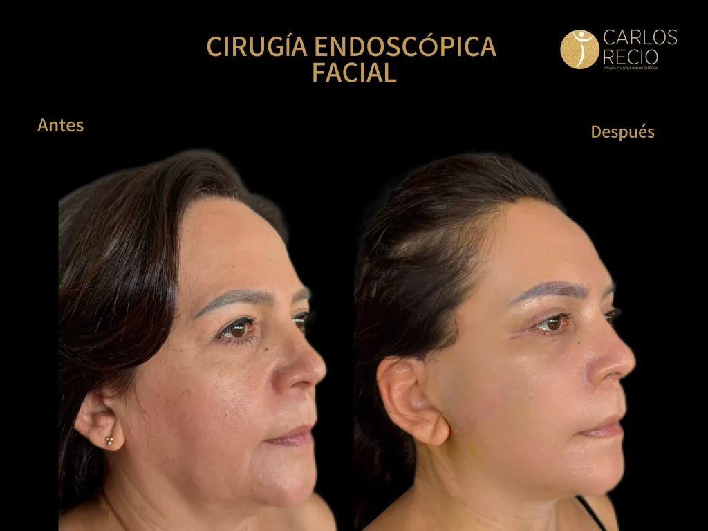Cirugía Endoscópica Facial: Rejuvenece el Tercio Superior sin Cicatrices Visibles Cirugía Endoscópica