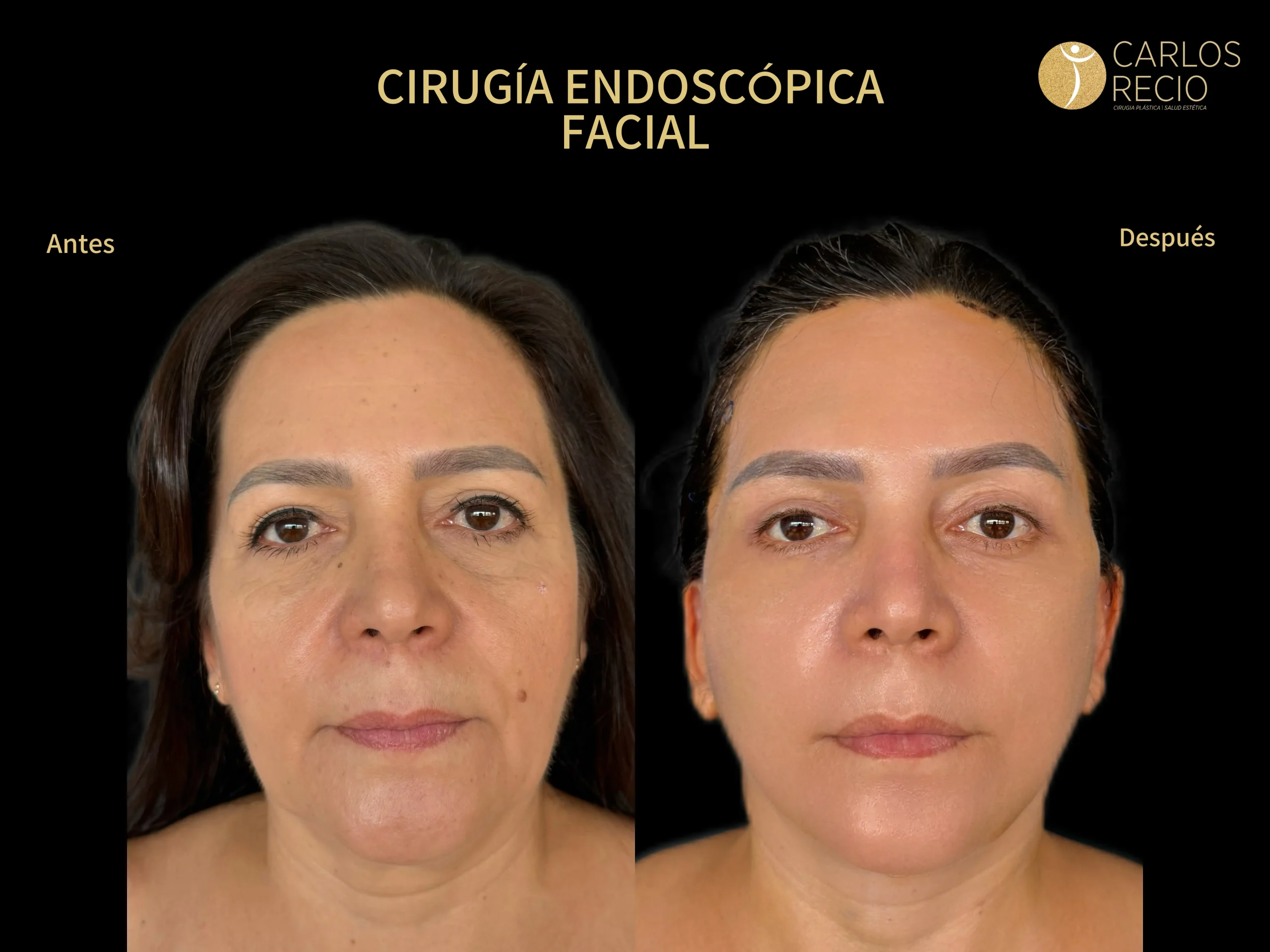 Cirugía Endoscópica Facial IMG_5549