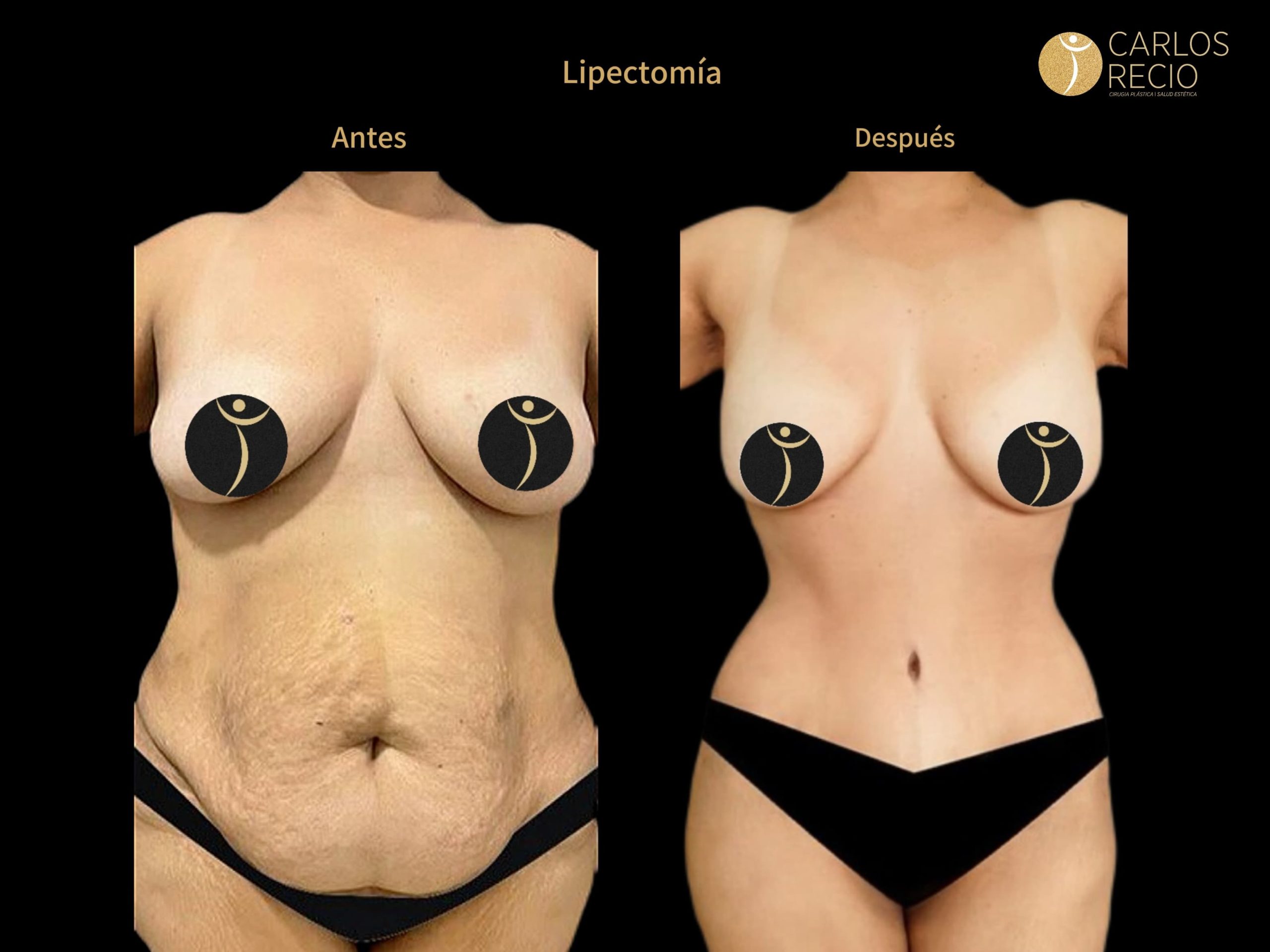 Dr. Carlos Recio Cirujano plástico en Cali LIPECTOMIA