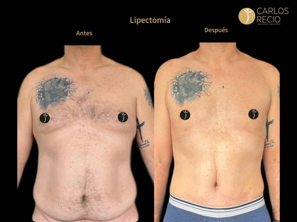 Lipectomía y Liposucción Combinadas: Cuándo se Realizan en la Misma Cirugía lipectomia
