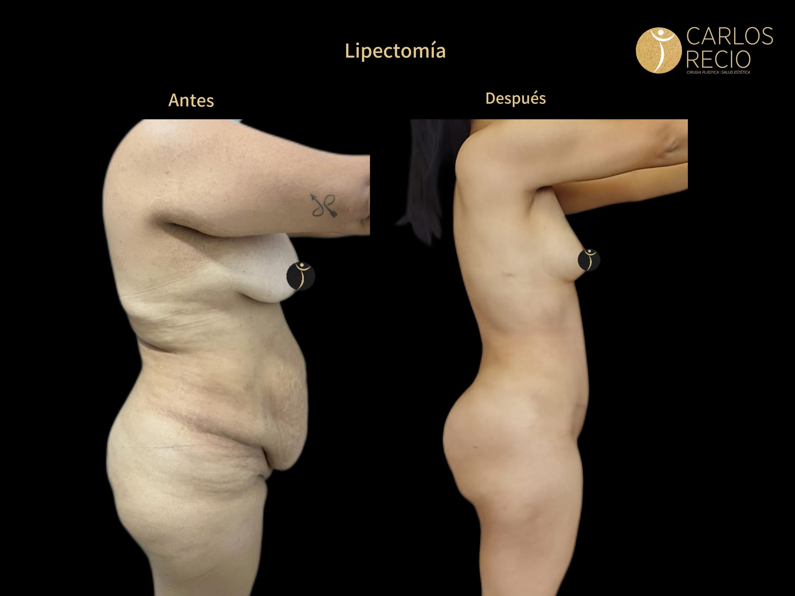 Dr. Carlos Recio Cirujano plástico en Cali LIPECTOMIAJPG