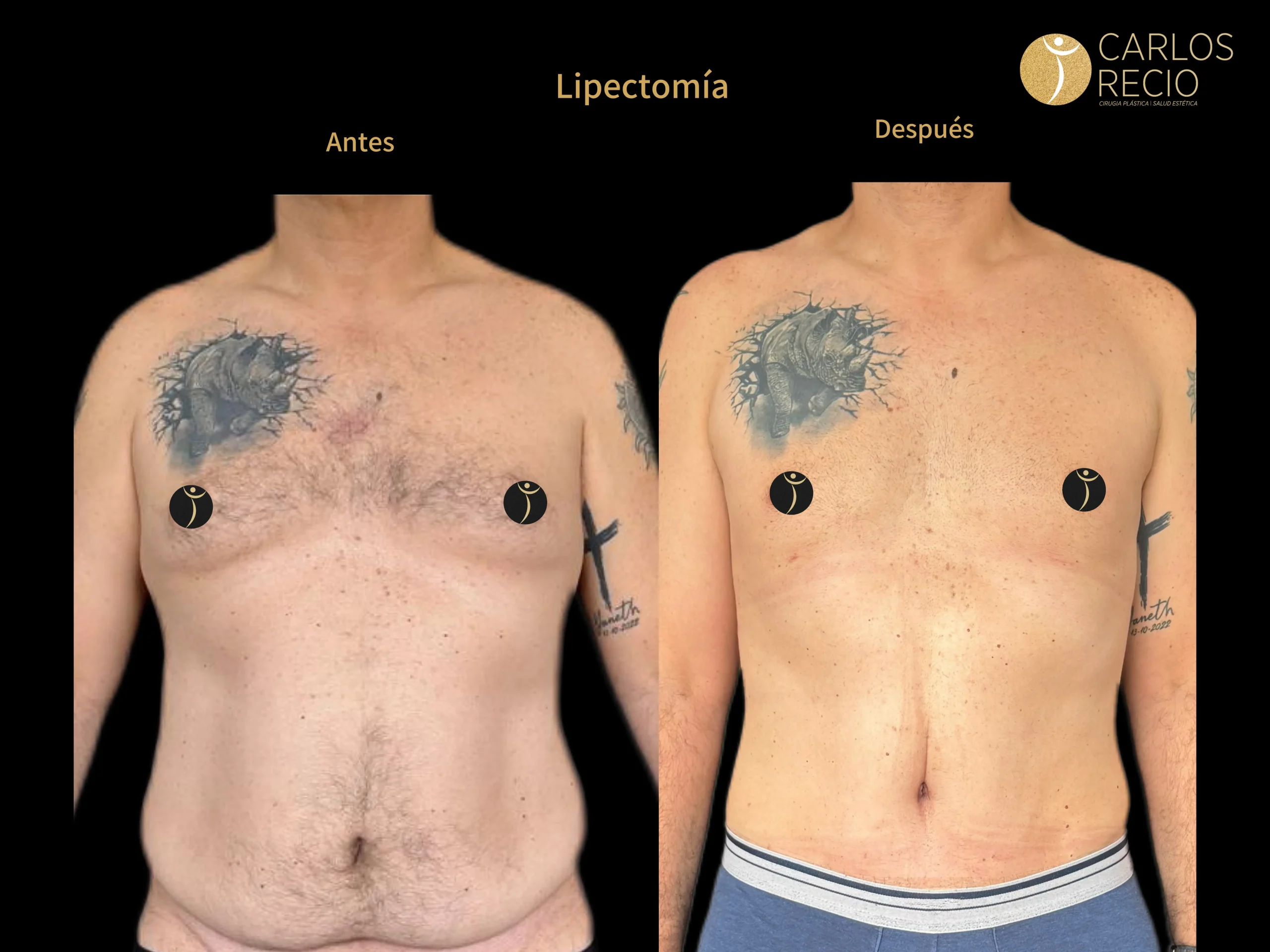 Procedimientos para Hombres en Cali LIPECTOMIAJPG