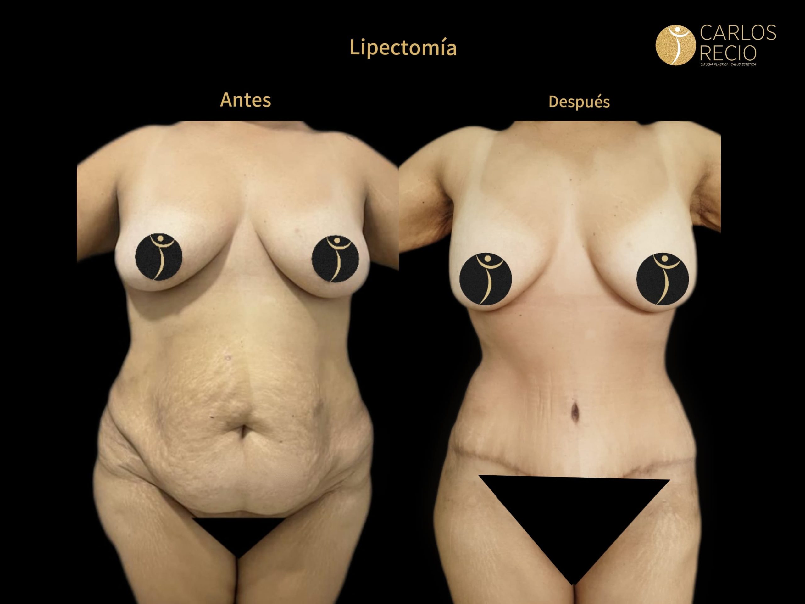 Dr. Carlos Recio Cirujano plástico en Cali LIPECTOMIAJPG(1)