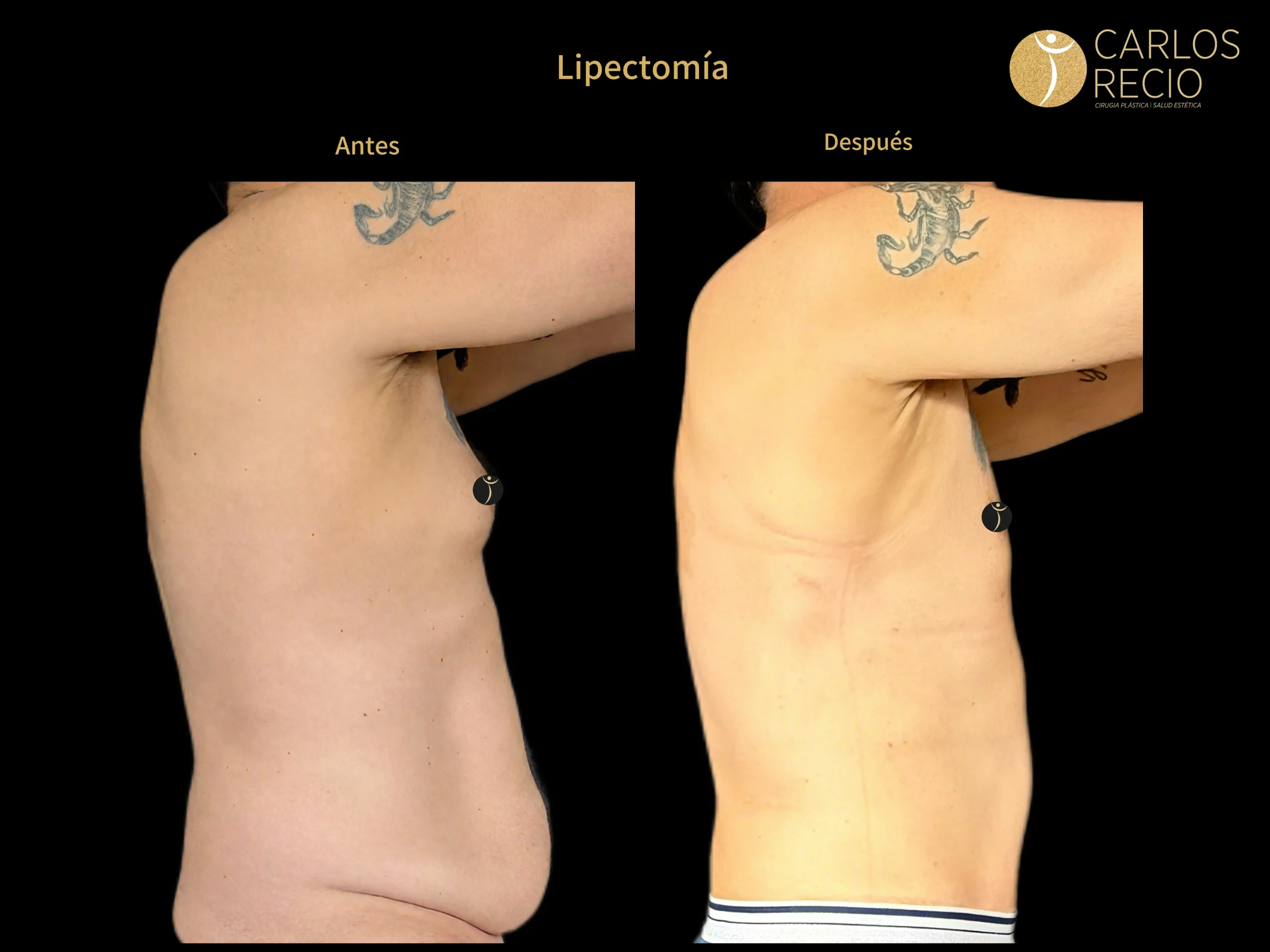 Procedimientos para Hombres en Cali LIPECTOMIAPG