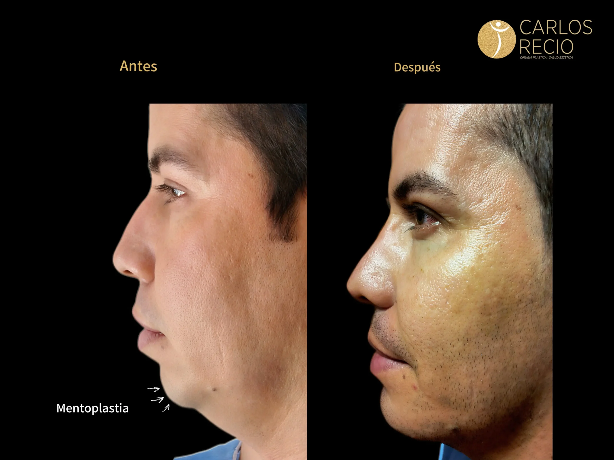 Procedimientos para Hombres en Cali MENTOPLASTIA PG