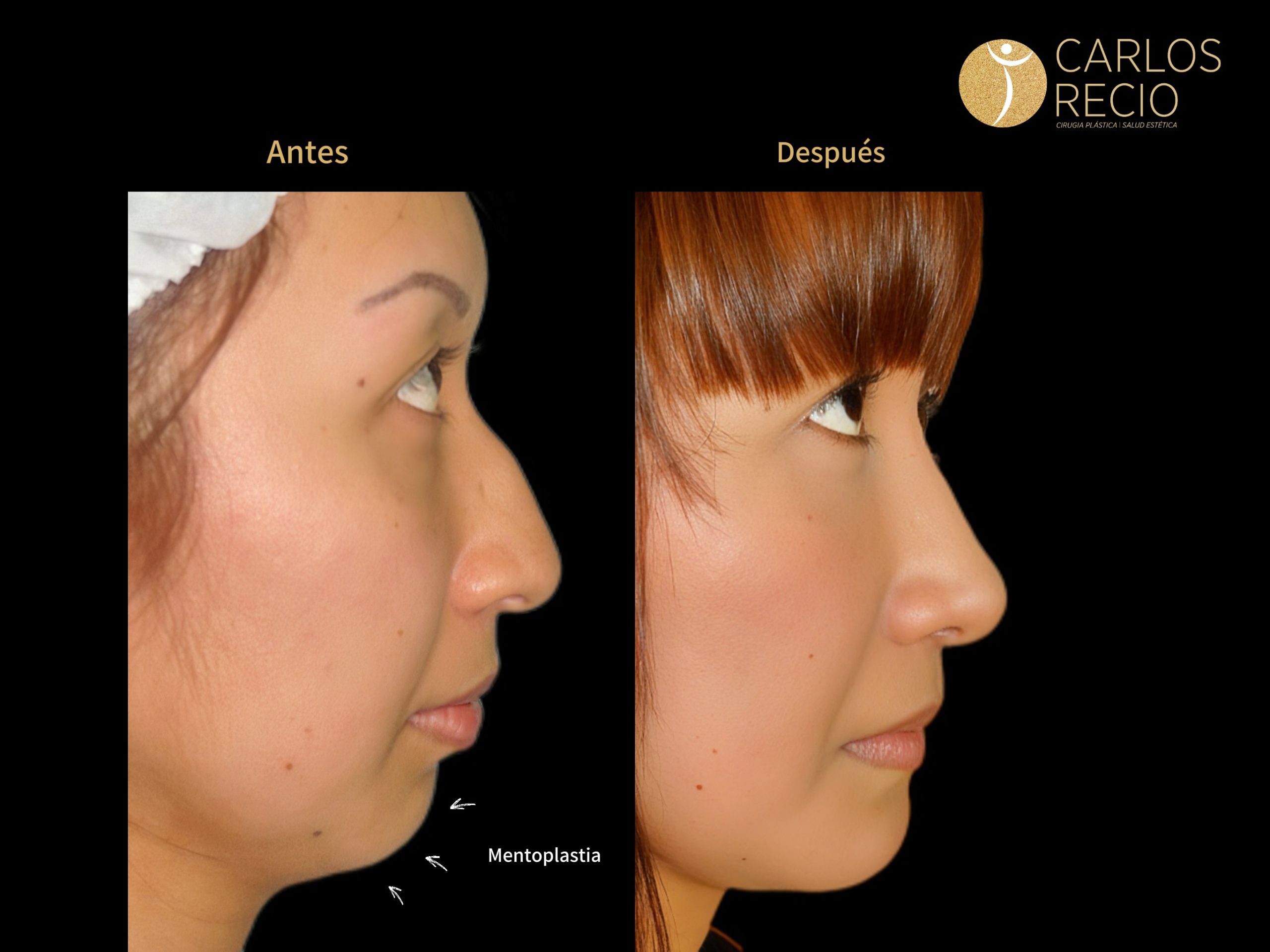 procedimientos faciales en Cali MENTOPLASTIA