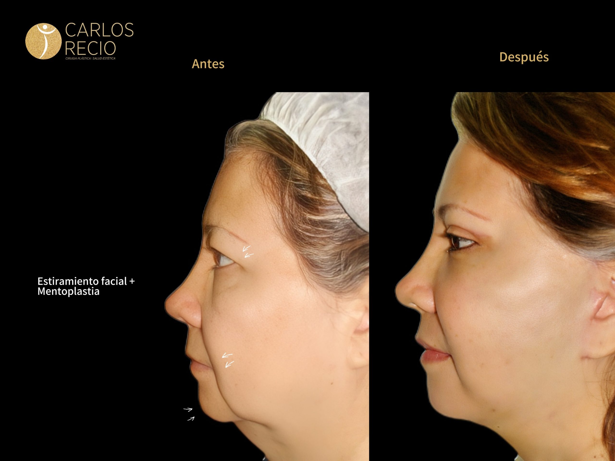 procedimientos faciales en Cali MENTOPLASTIA