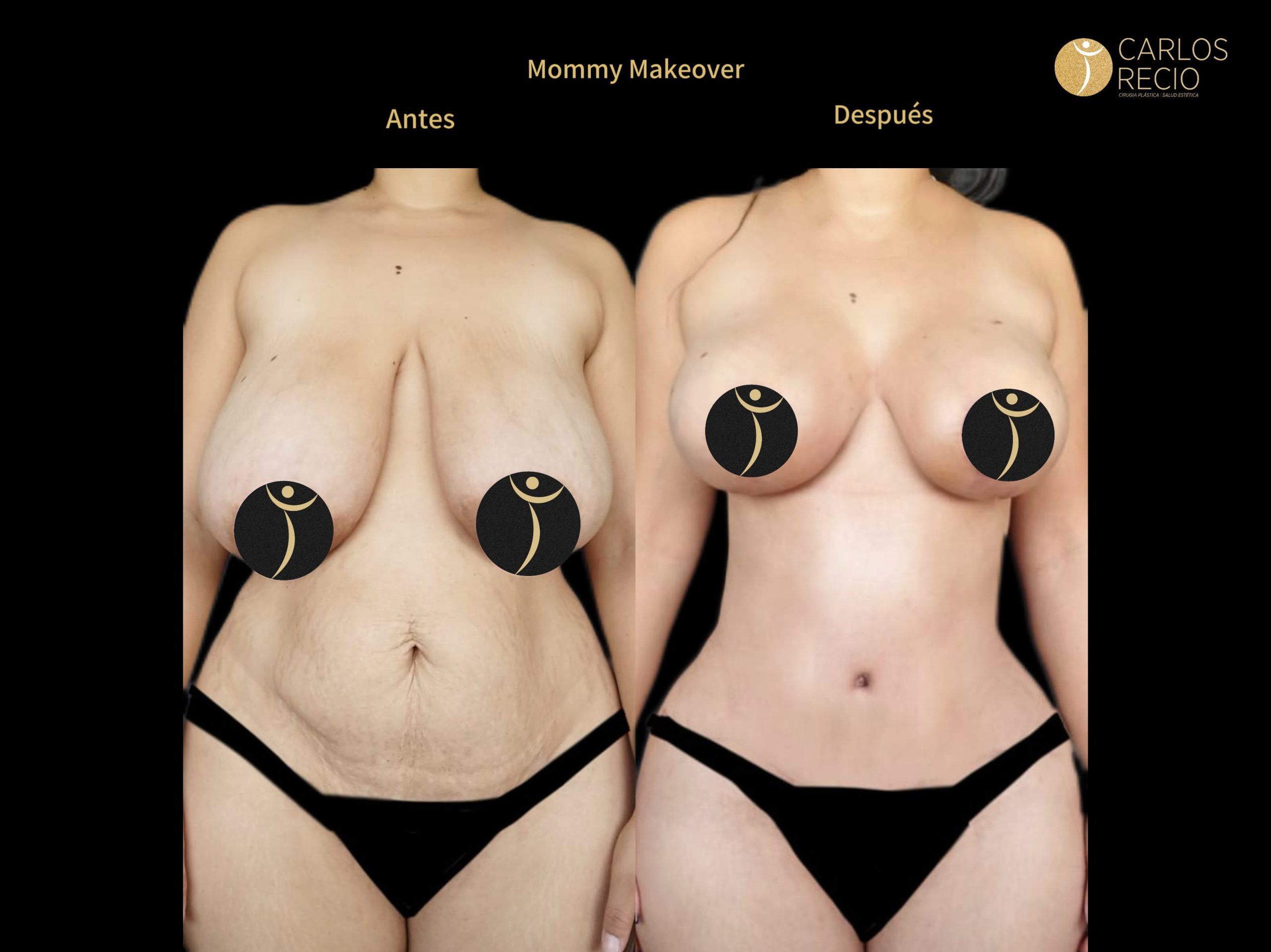 Dr. Carlos Recio Cirujano plástico en Cali MOMMY MAKEOVER