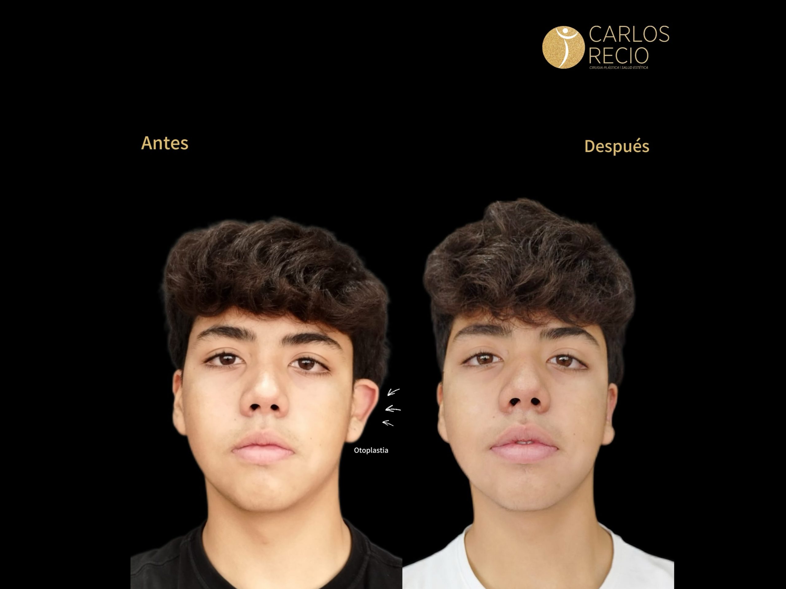 Procedimientos para Hombres en Cali otoplastia