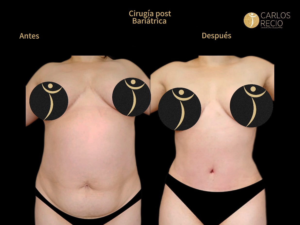Dr. Carlos Recio Cirujano plástico en Cali POST BARIATRICA