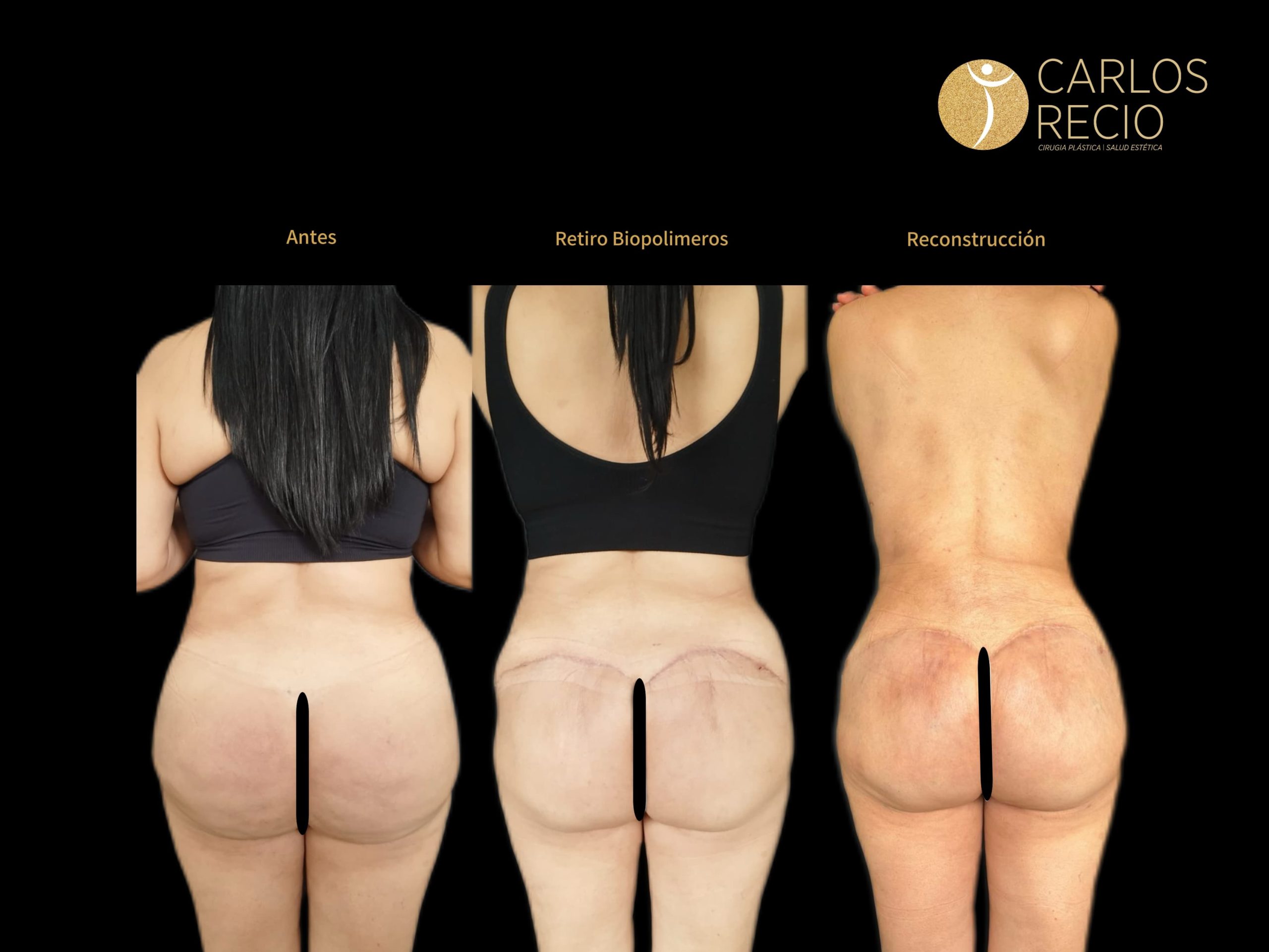 Dr. Carlos Recio Cirujano plástico en Cali RETIRO BIOPOLIMEROS