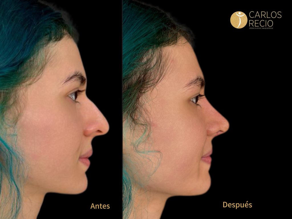 Rinoplastia: la cirugía que transforma tu perfil Rinoplastia: la cirugía que transforma tu perfil