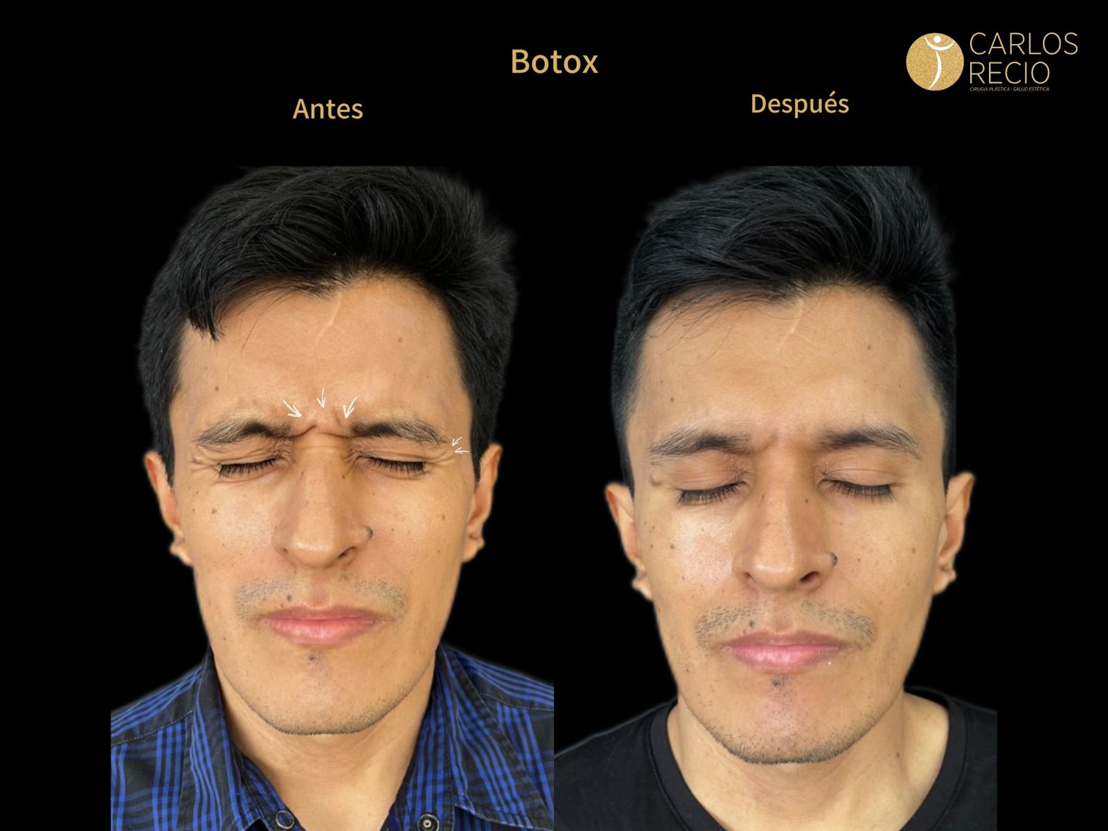 Procedimientos para Hombres en Cali botox