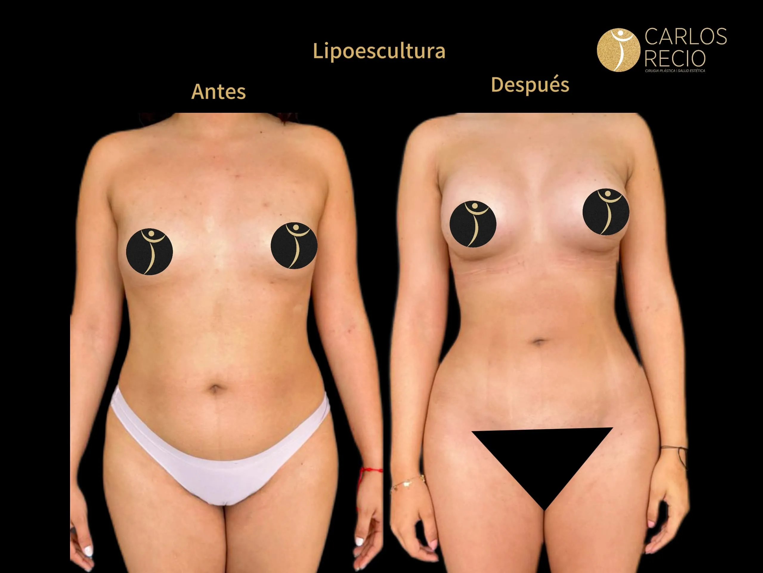 cirugía corporal LIPOESCULTURA