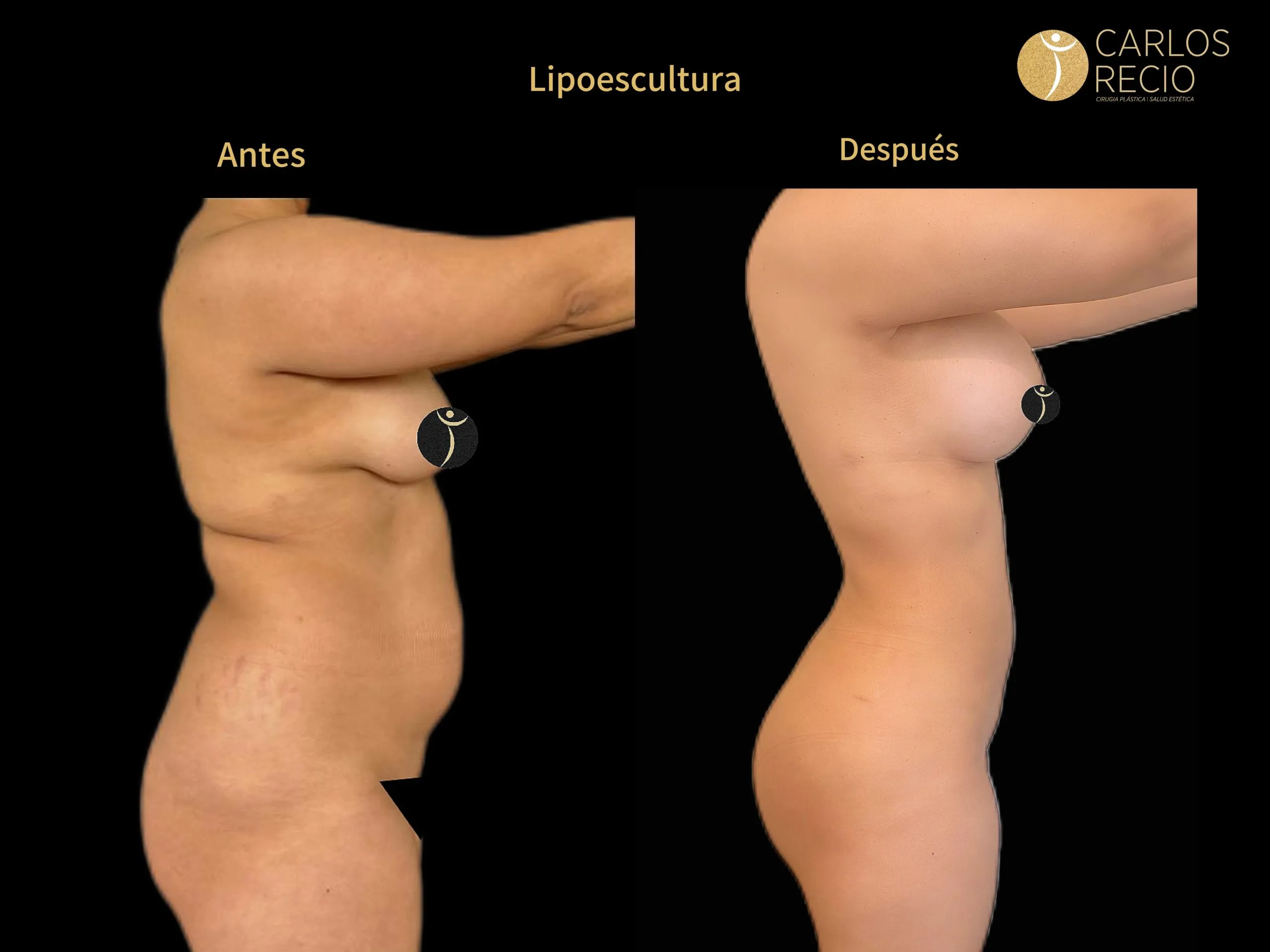 cirugía corporal LIPOESCULTURA