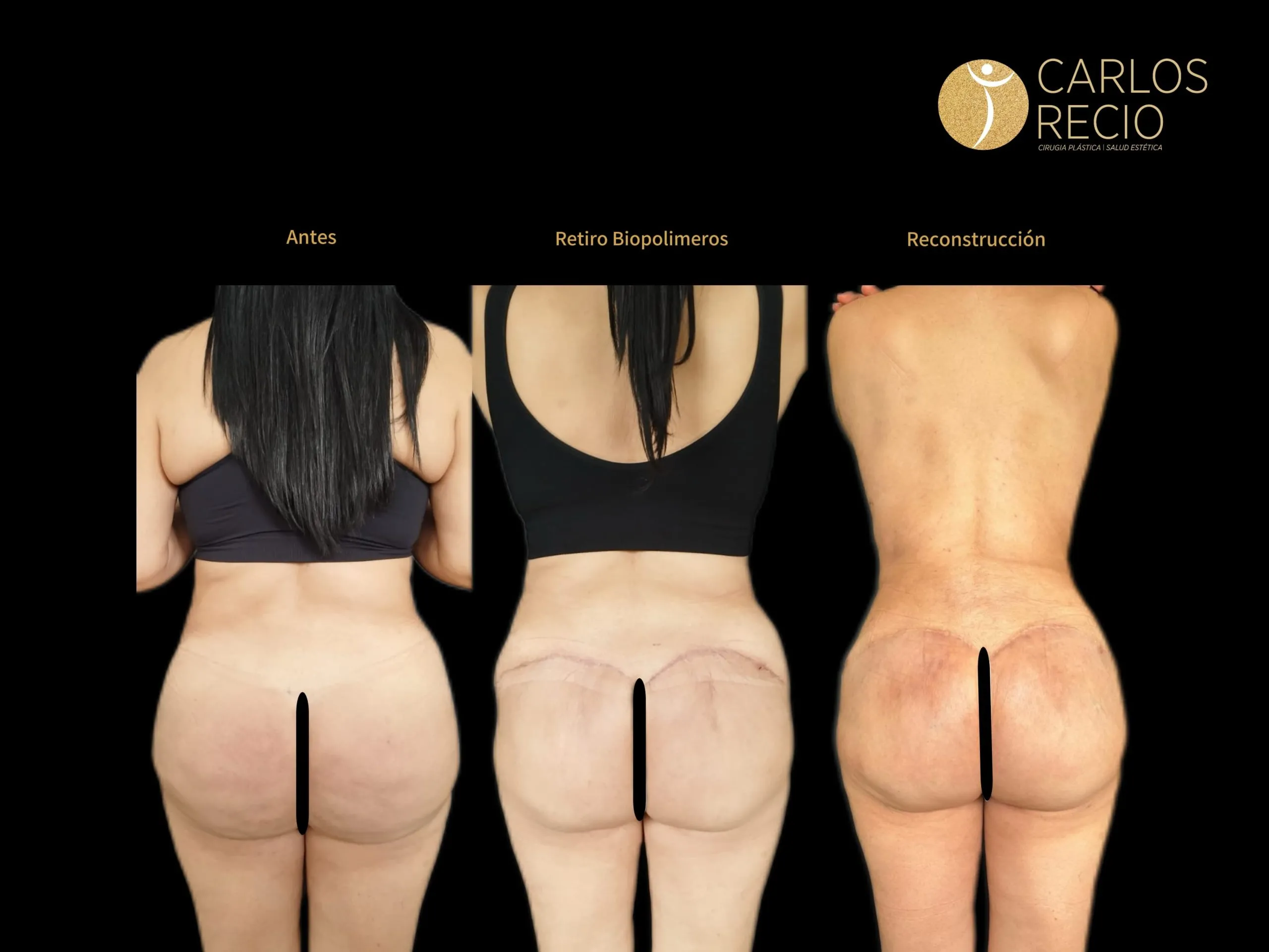 cirugía corporal RETIRO-BIOPOLIMEROS