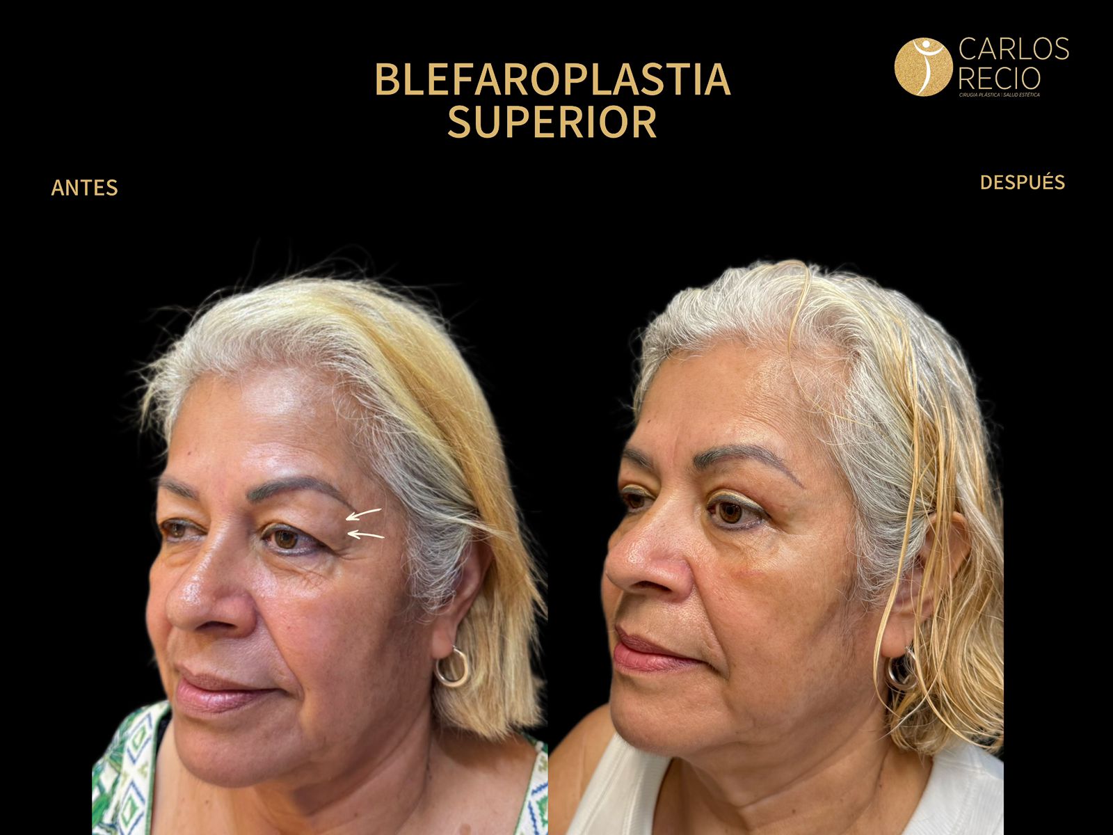 procedimientos faciales en Cali Blefaroplastia superior